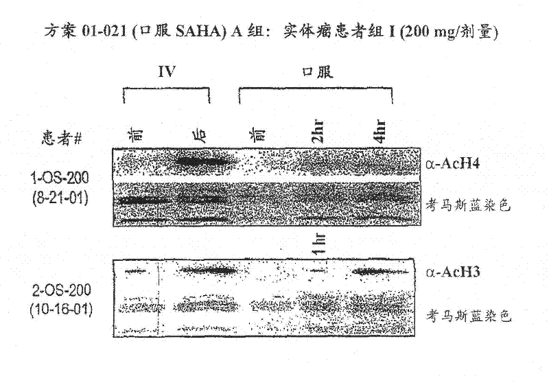 Method of treating cancer with HDAC inhibitors