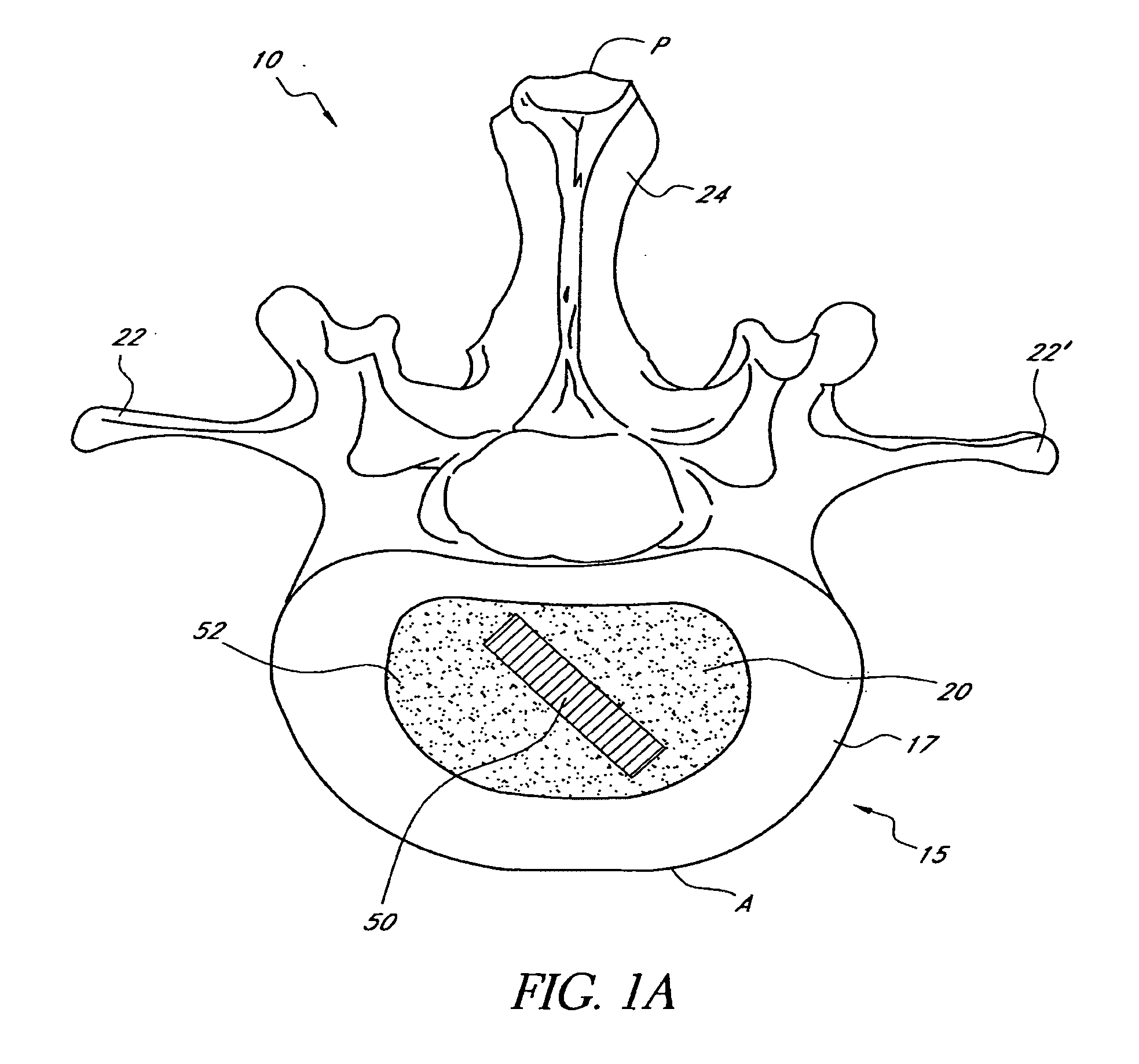 Method of monitoring characteristics of an intervertebral disc and implantable prosthetic