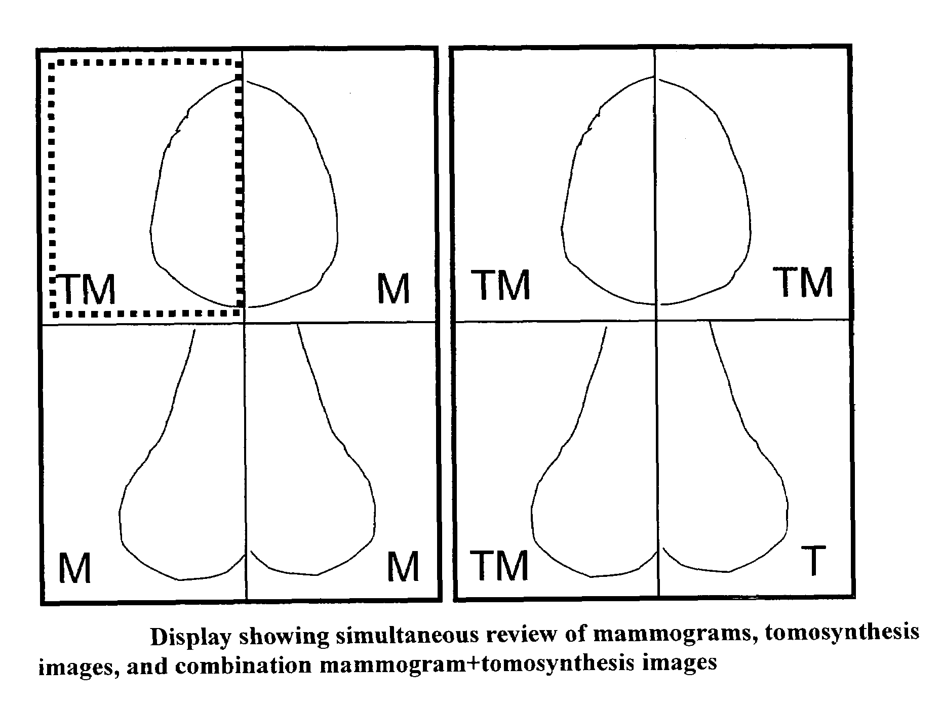 Image handling and display in X-ray mammography and tomosynthesis