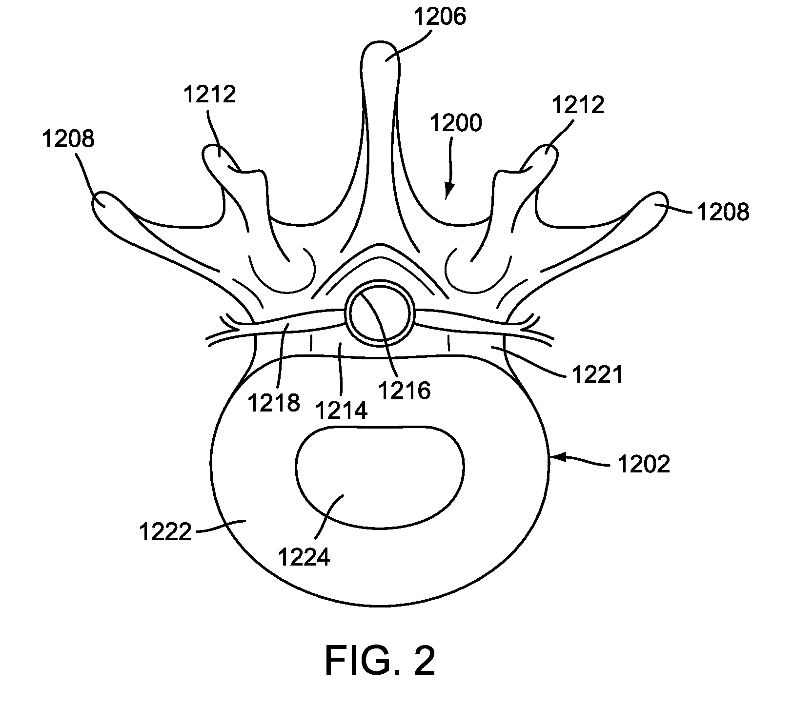 Disk Fusion Implant