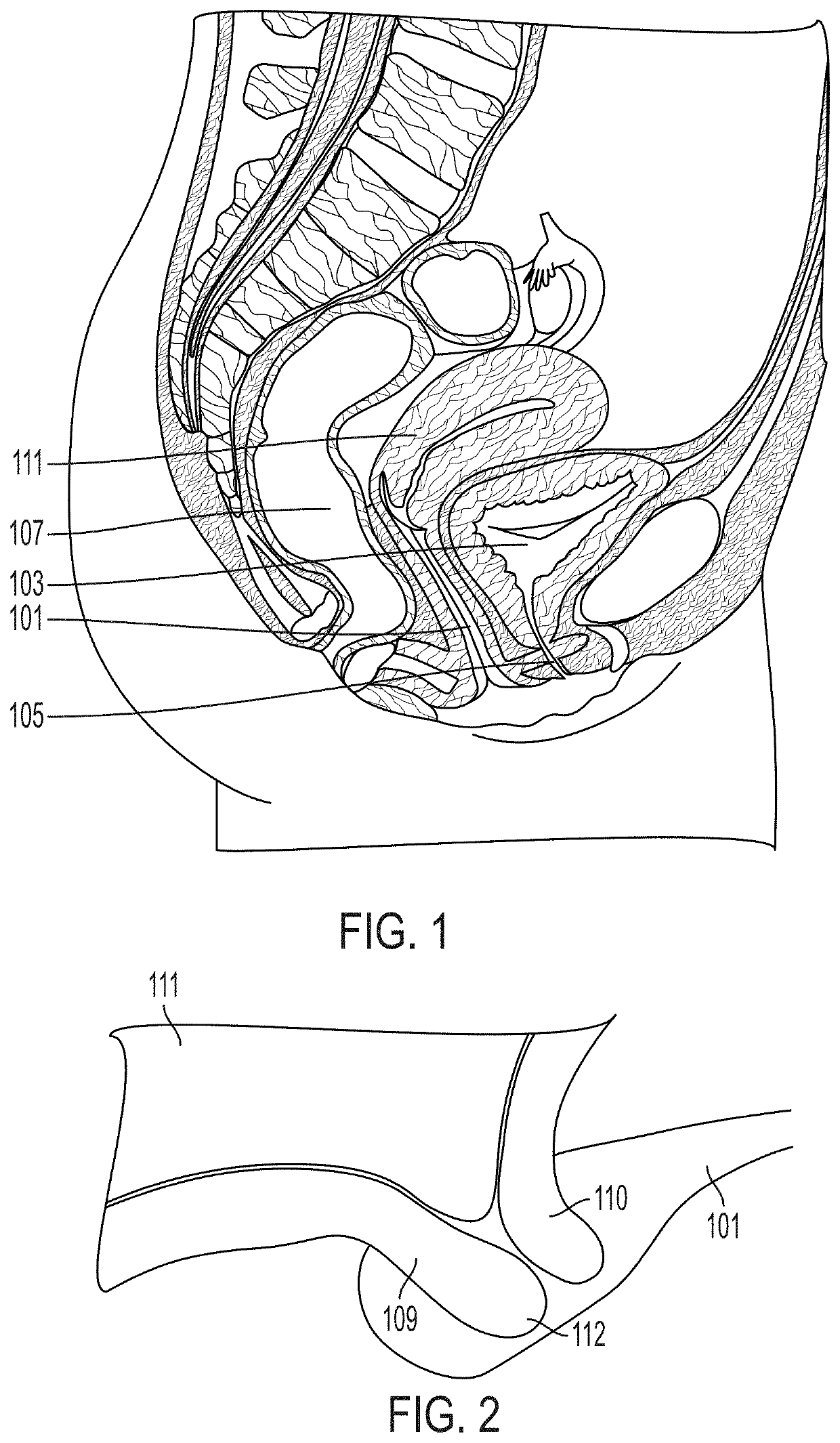 Pessary device and methods for preventing premature births