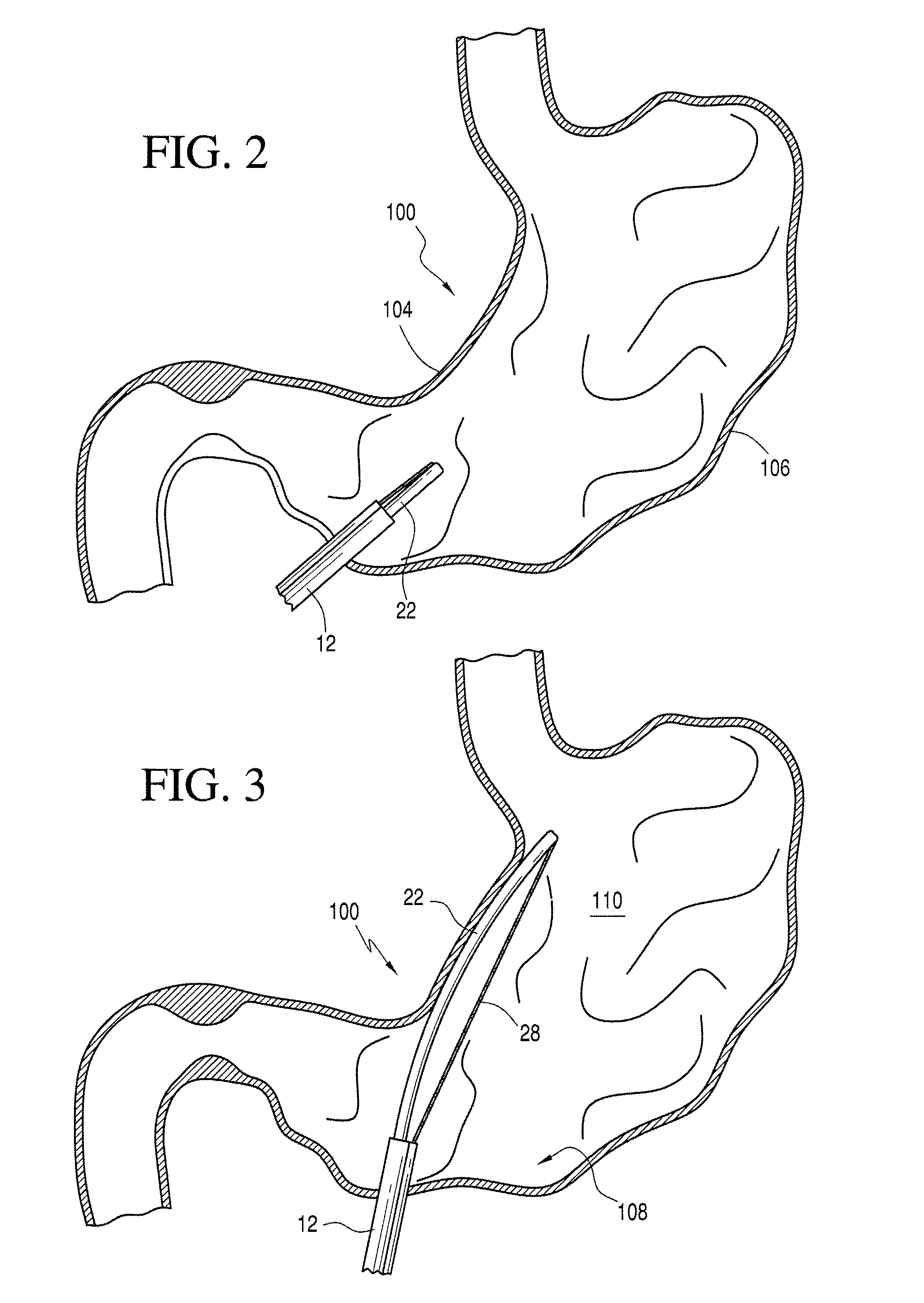 Gastric coil manipulator