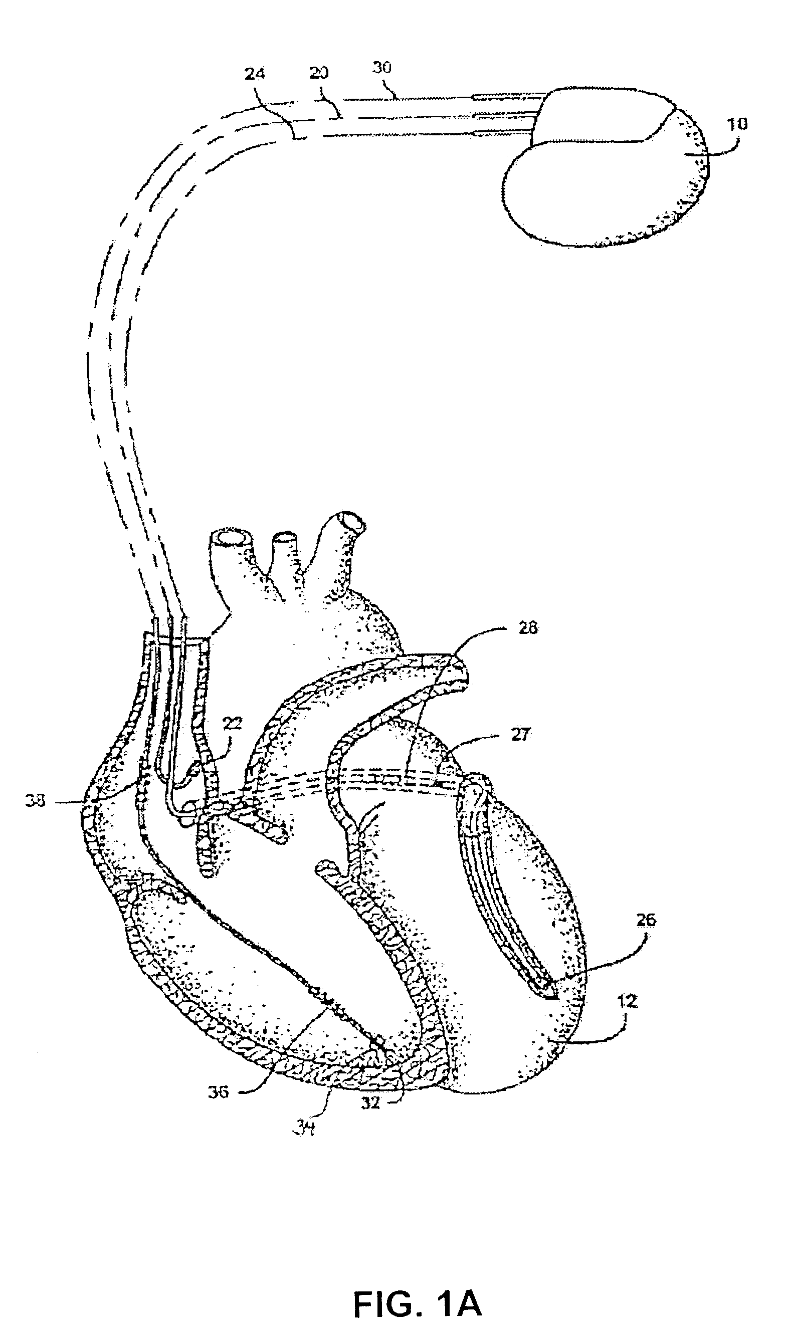 System and method for delivering post-atrial arrhythmia therapy