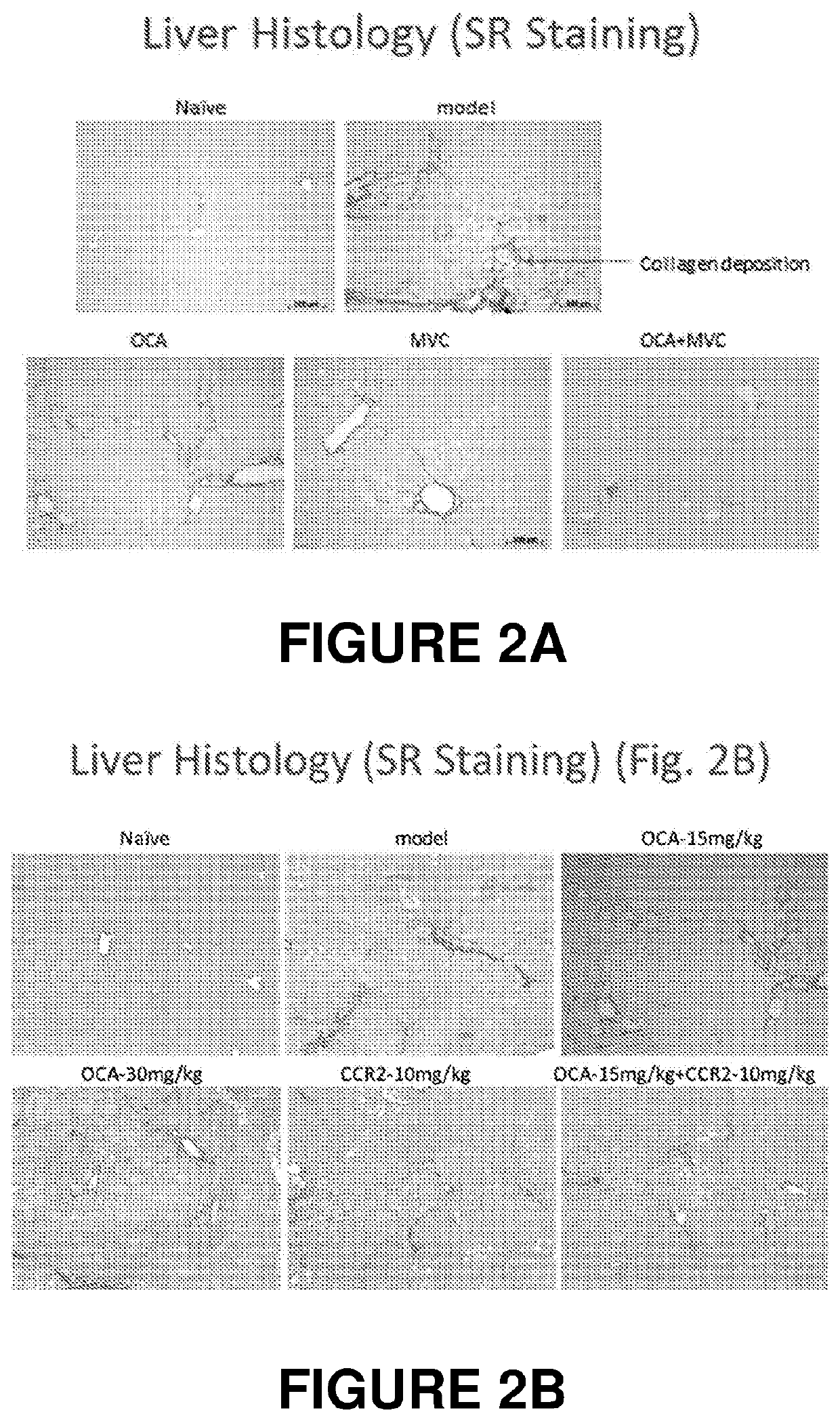 Combination therapy for nonalcoholic steatohepatitis (NASH) and liver fibrosis