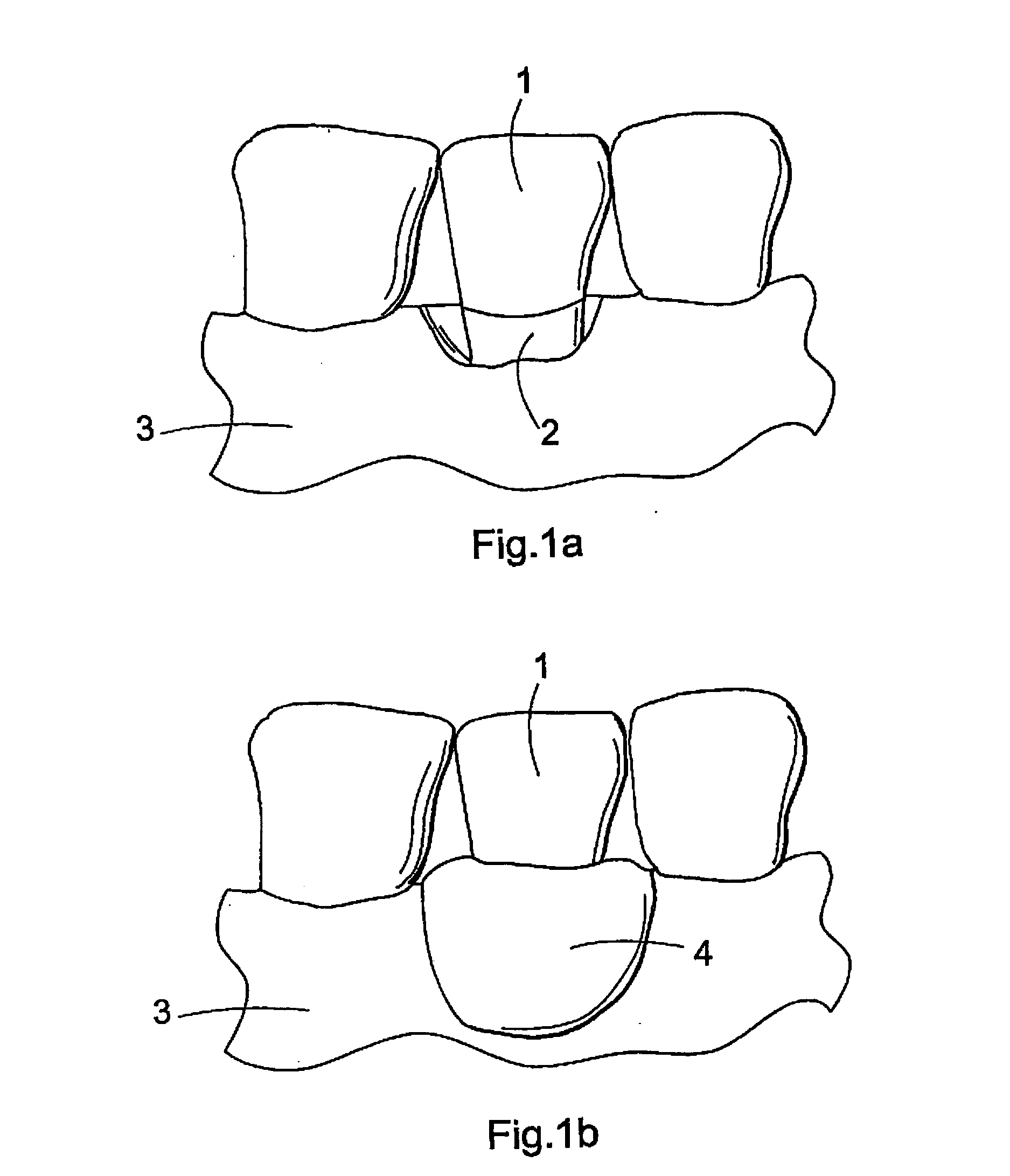 Biodegradable implant and method for manufacturing one