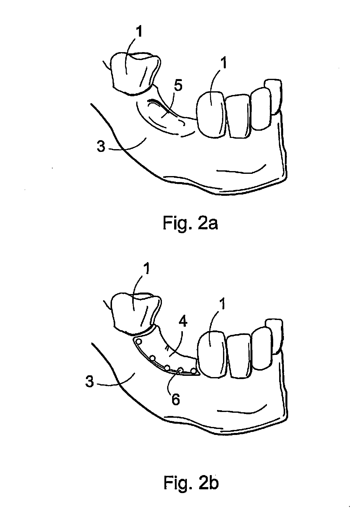 Biodegradable implant and method for manufacturing one