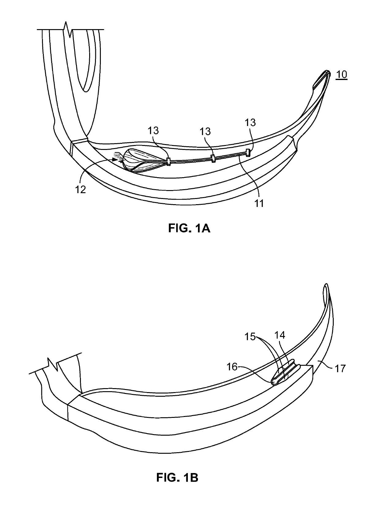 Integrated video laryngoscope mounted stylet and deployment system for endotracheal tubes and double-lumen endobronchial tubes