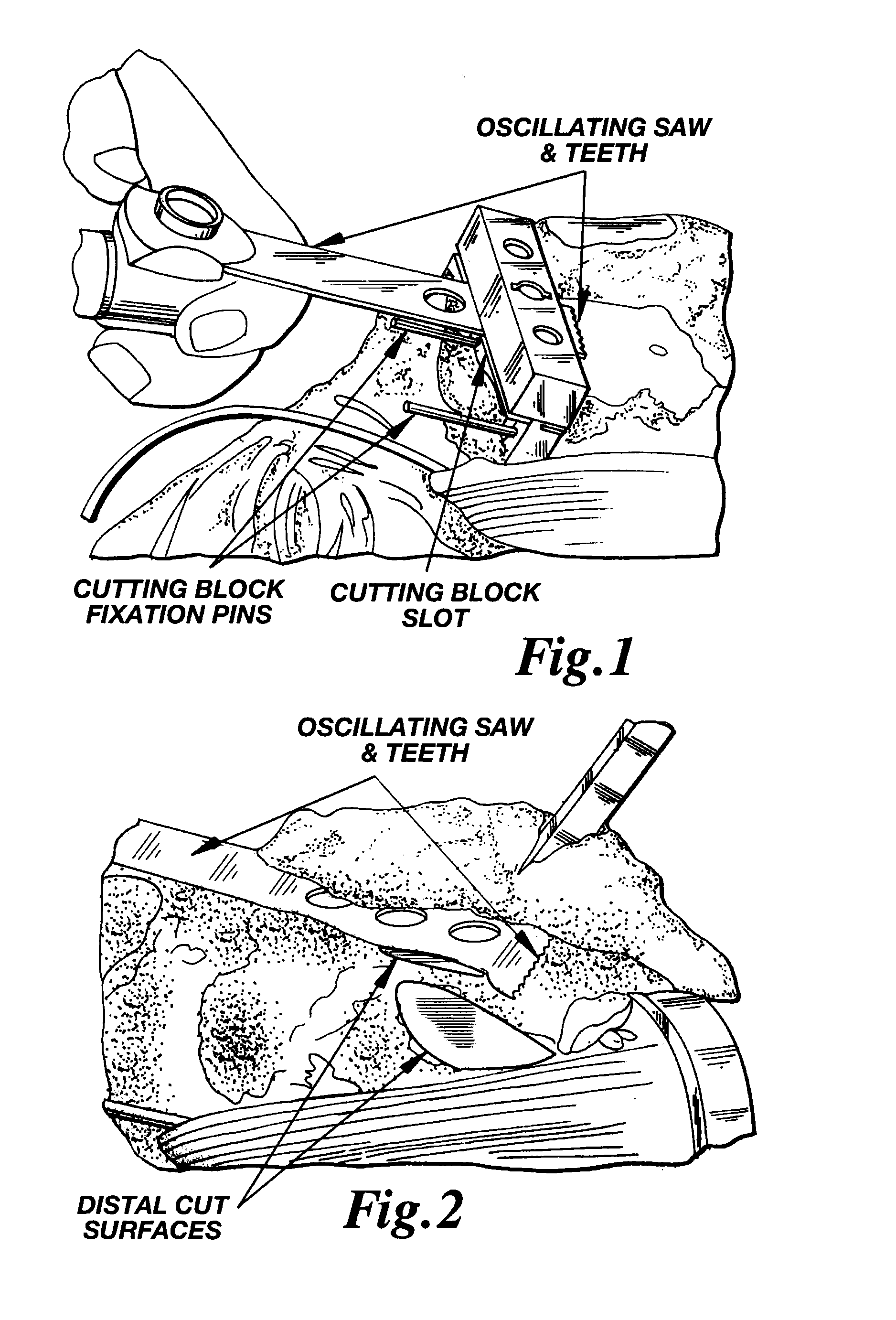 Methods and apparatus for pinplasty bone resection