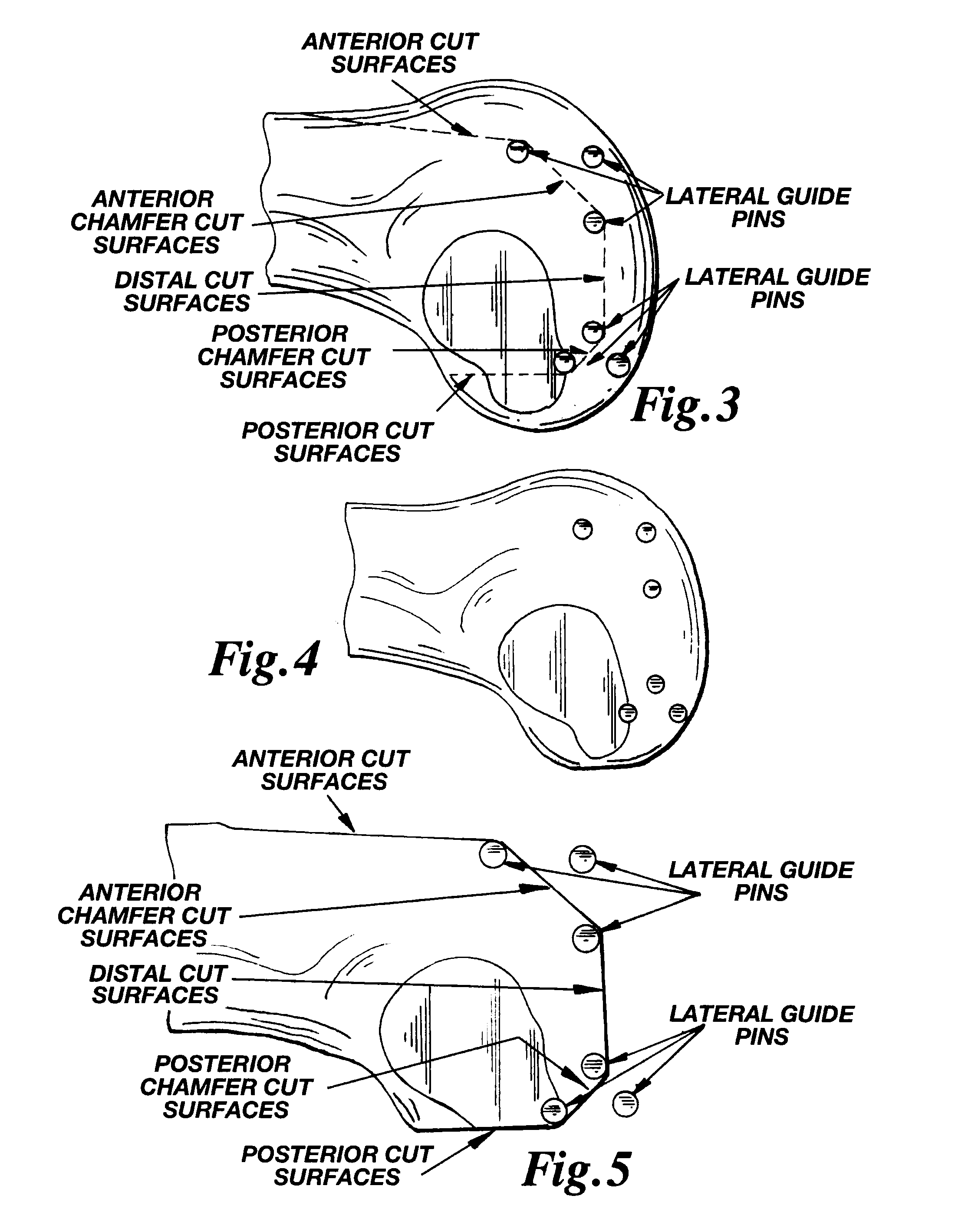 Methods and apparatus for pinplasty bone resection