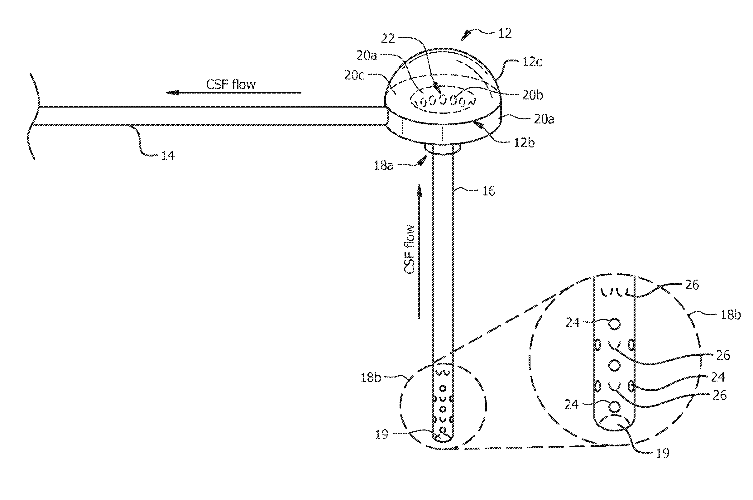 Shunt catheter system