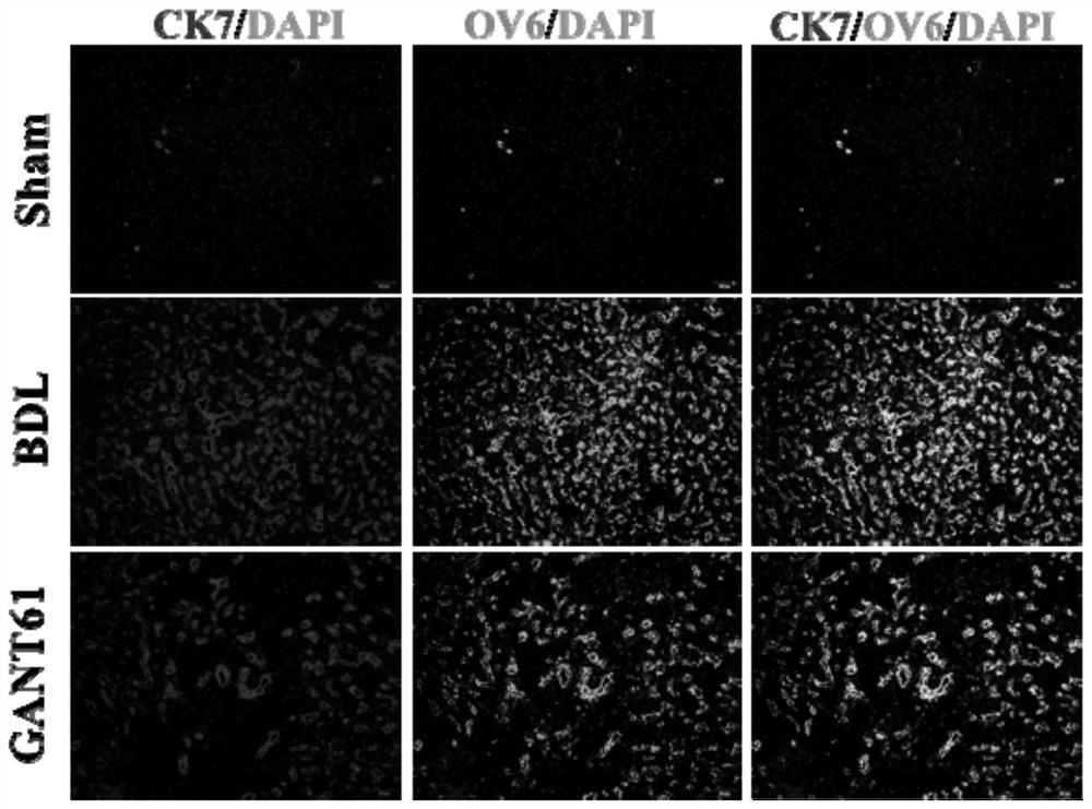 Application of Gli1 inhibitor to preparation of medicines for treating cholestatic liver fibrosis and liver cirrhosis