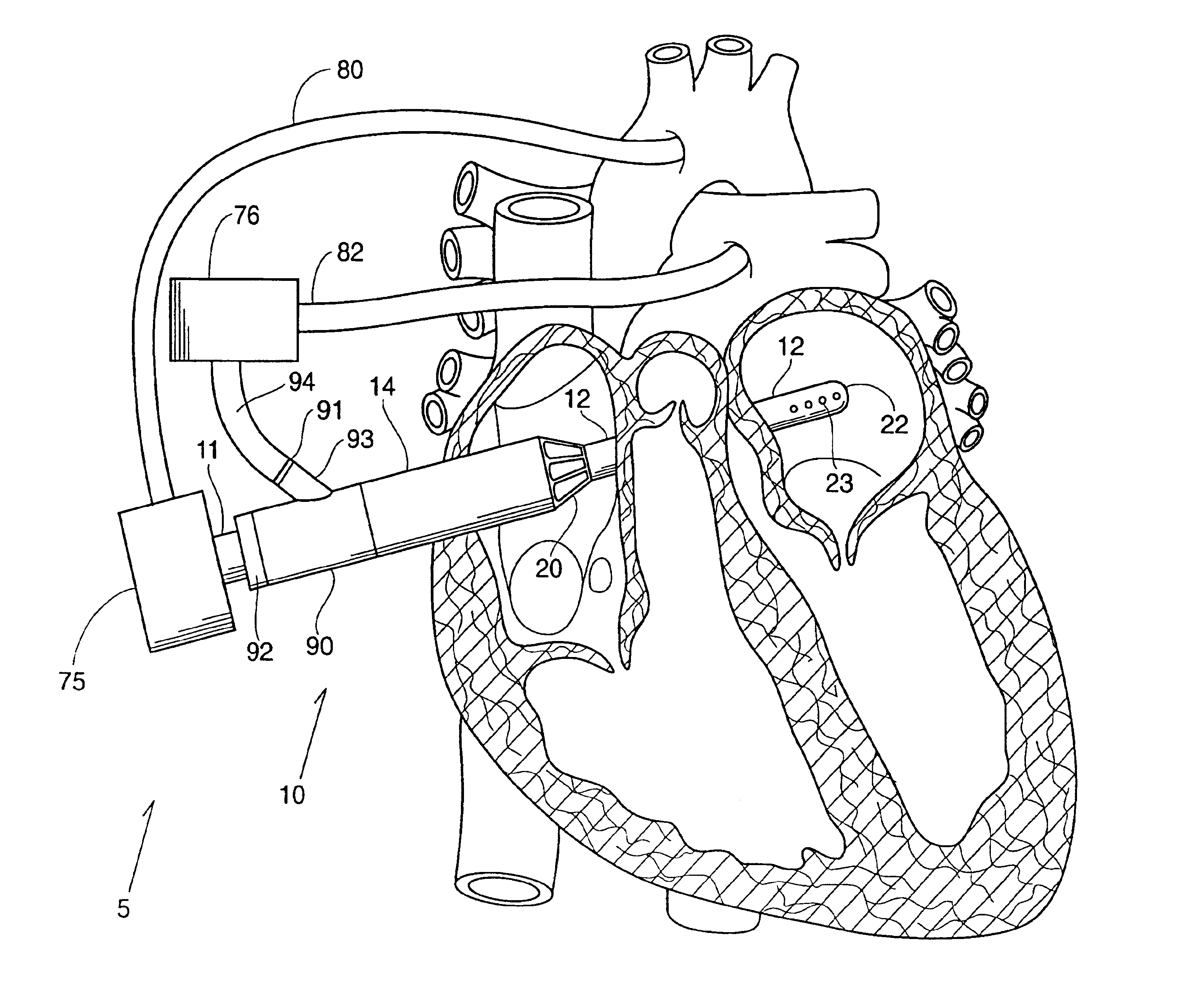 Left and right side heart support