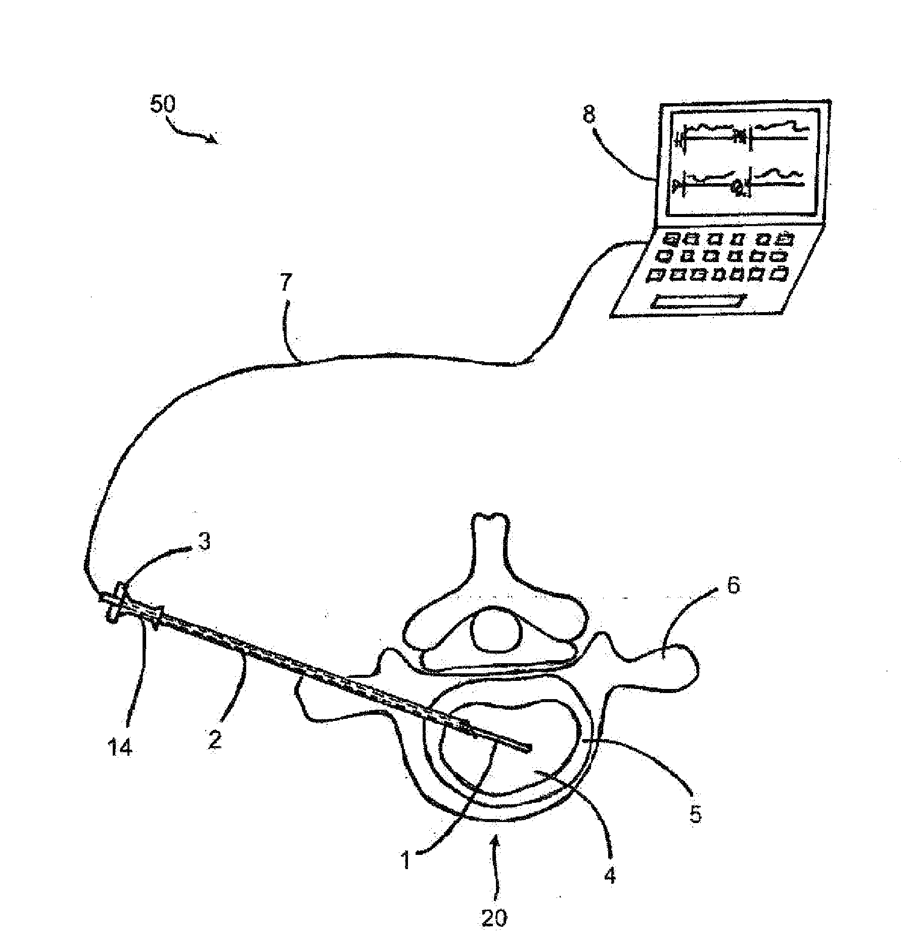 Intervertebral disc analysis system and method