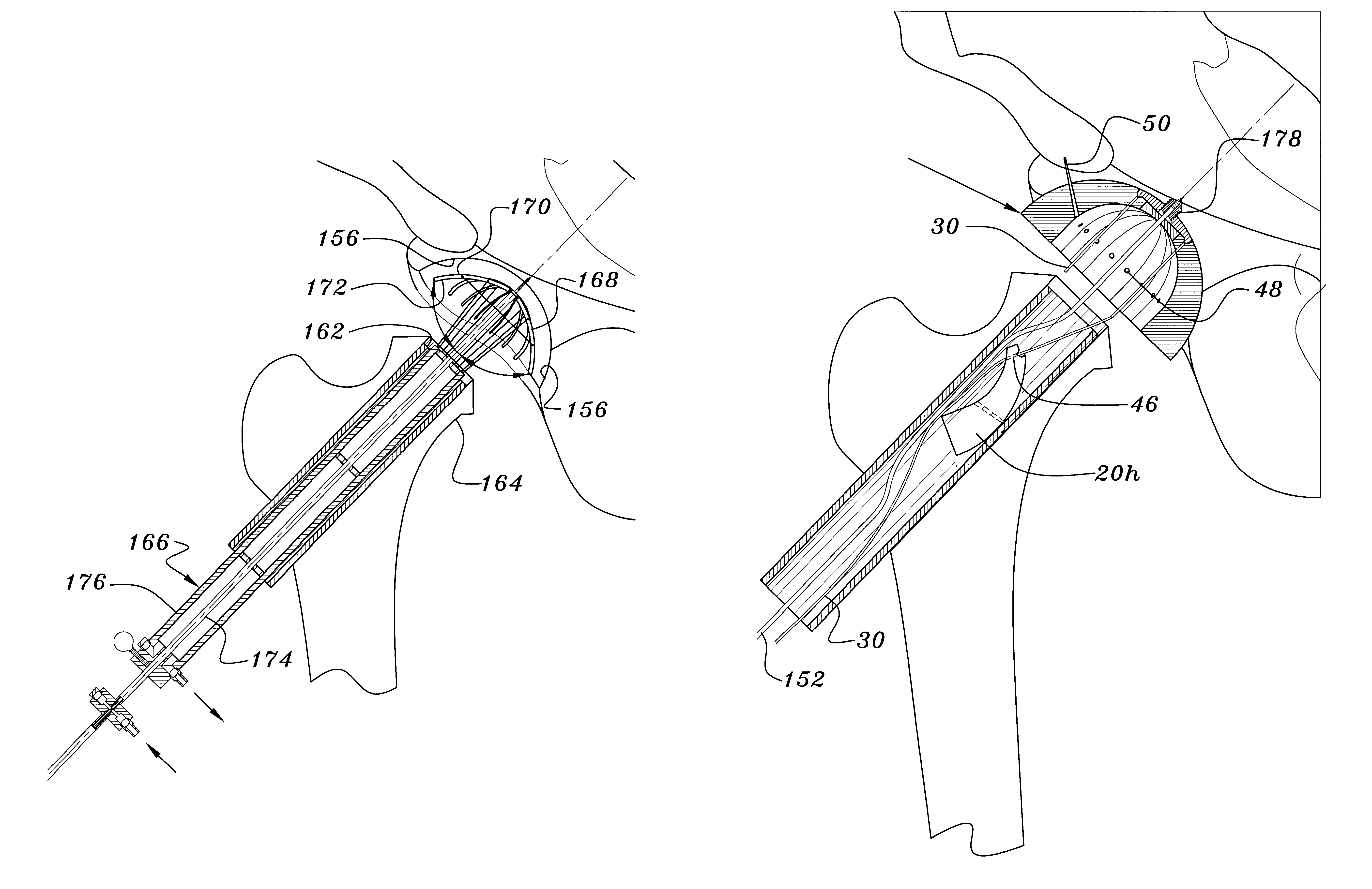 Joint prosthesis and method for placement