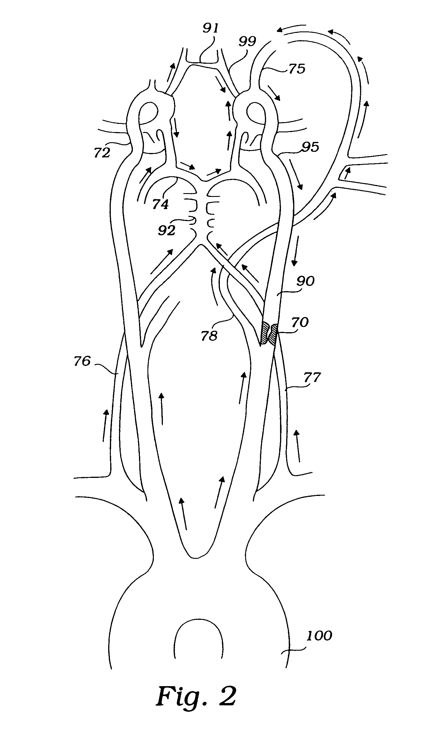 Devices and methods for preventing distal embolization using flow reversal by partial occlusion of the brachiocephalic artery