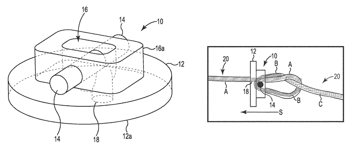 Adjustable suture restriction system and method