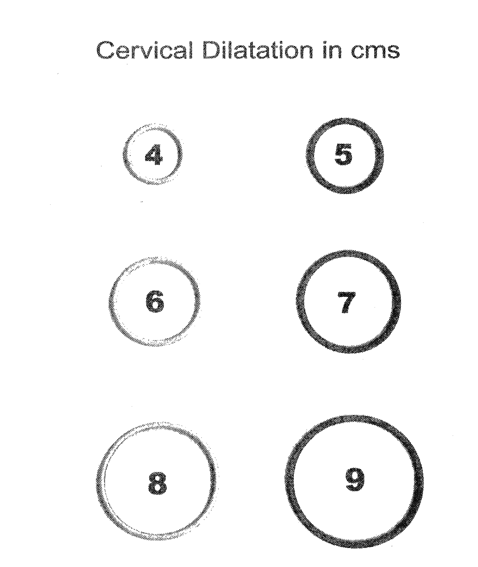 Color-coded rings for determining degree of cervical dilatation
