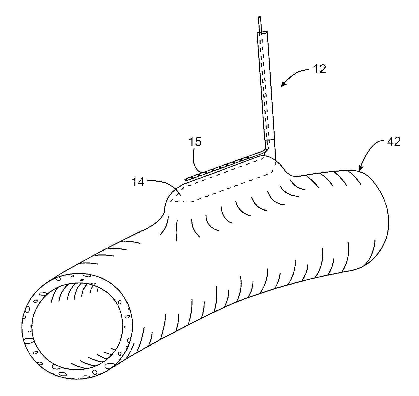 Tissue bonding system and method for controlling a tissue site during anastomosis
