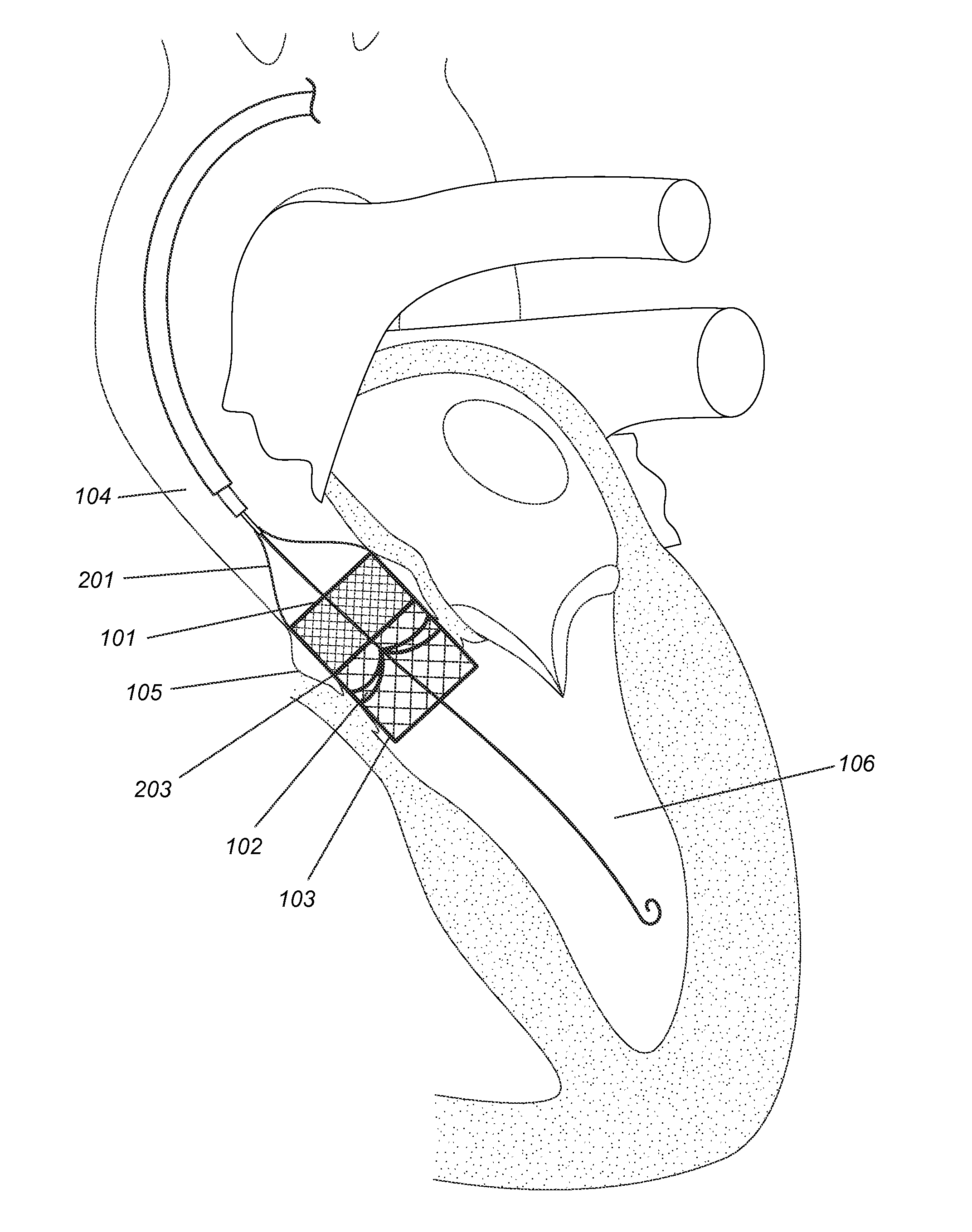 Modular dis-assembly of transcatheter valve replacement devices and uses thereof