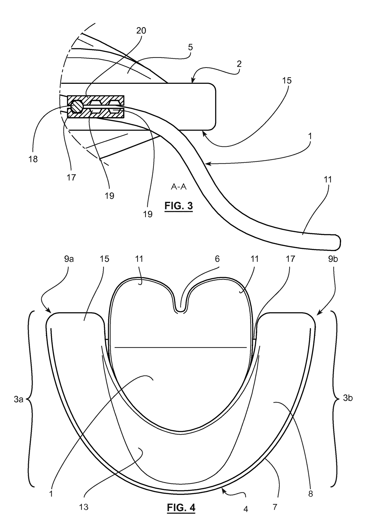 Intraoral device for the repositioning and rehabilitation of the tongue