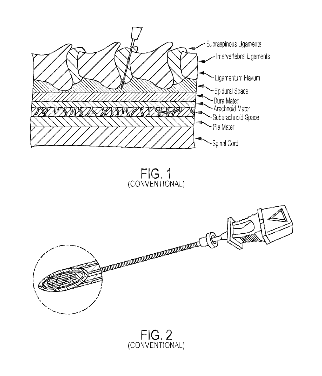 System for generating synthetic aperture ultrasound images during needle placement