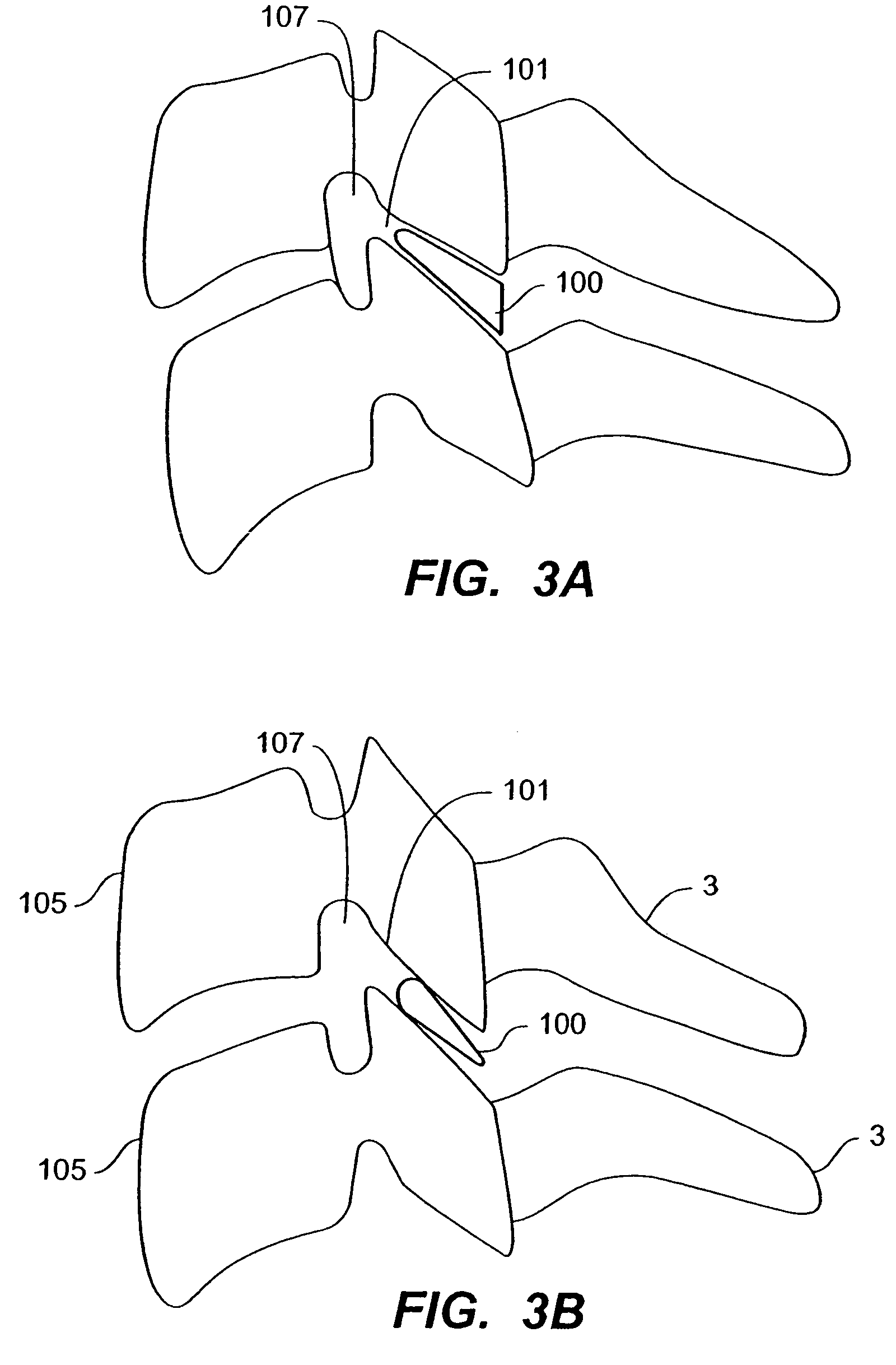 Inter-cervical facet implant with surface enhancements