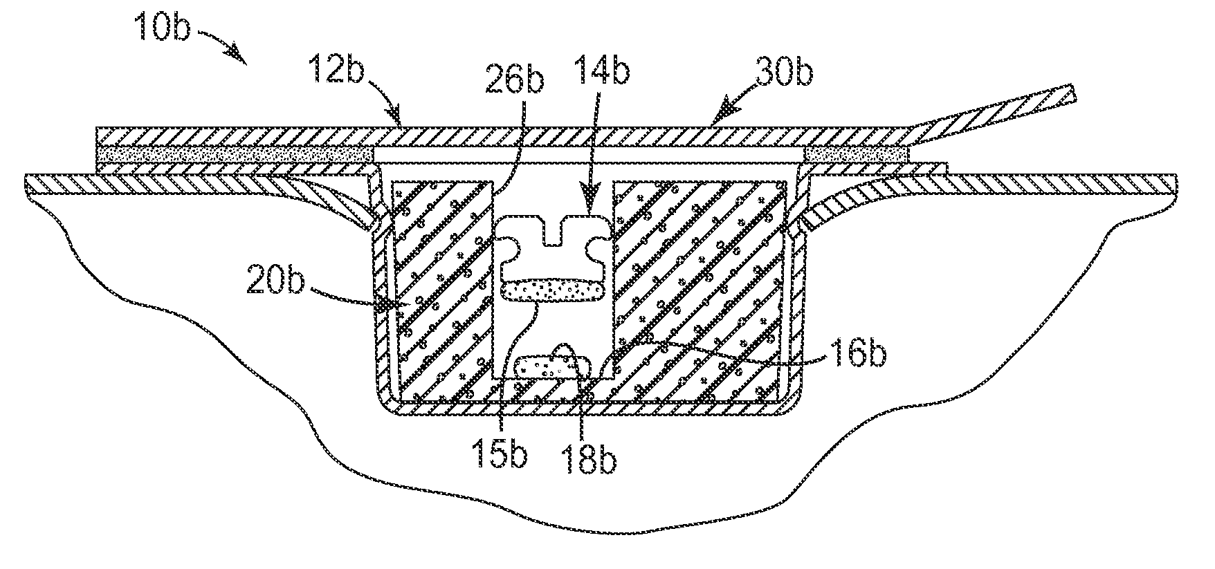 Packaged orthodontic appliance and adhesive material