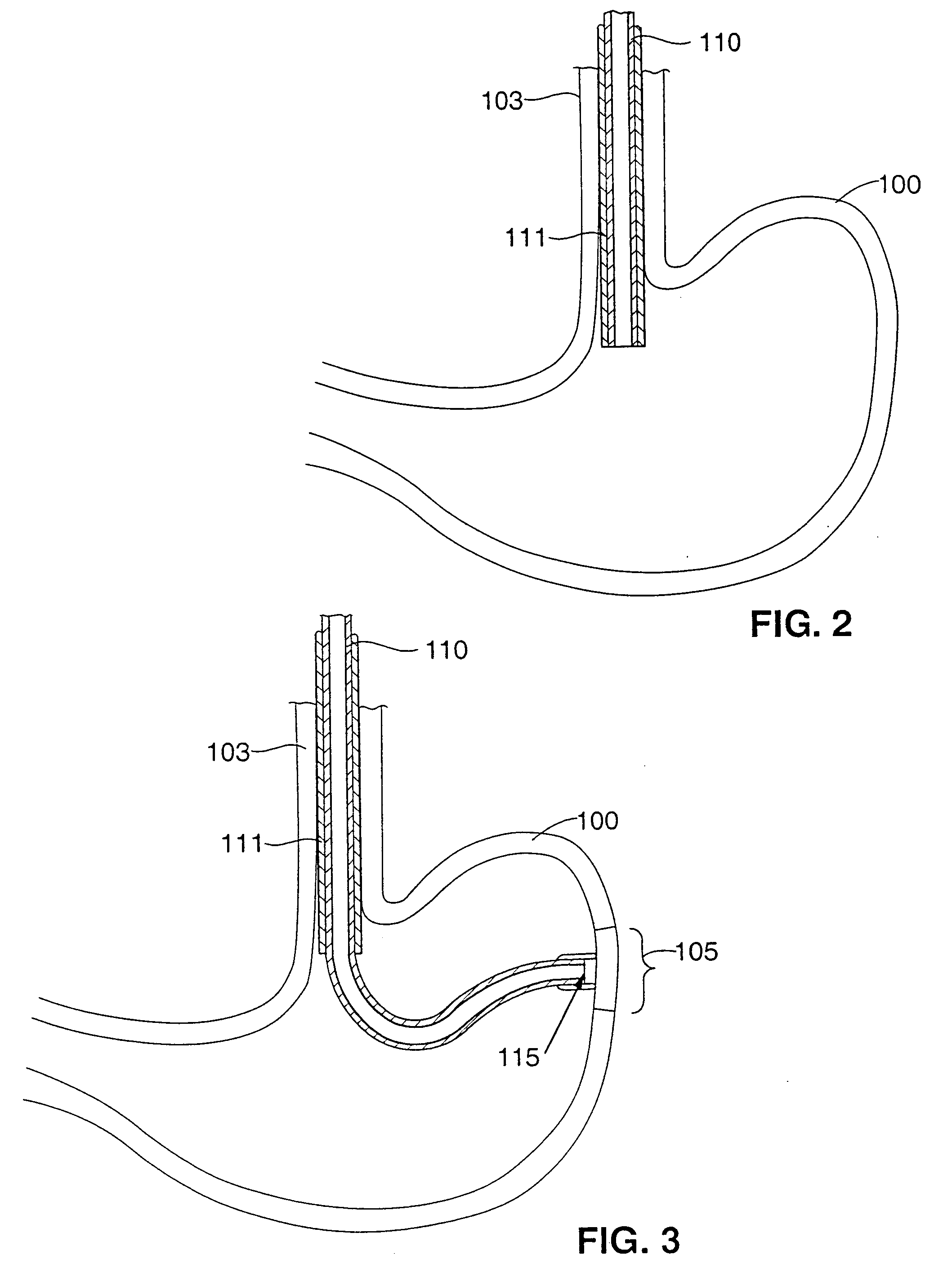 Gastric treatment and diagnosis device and method