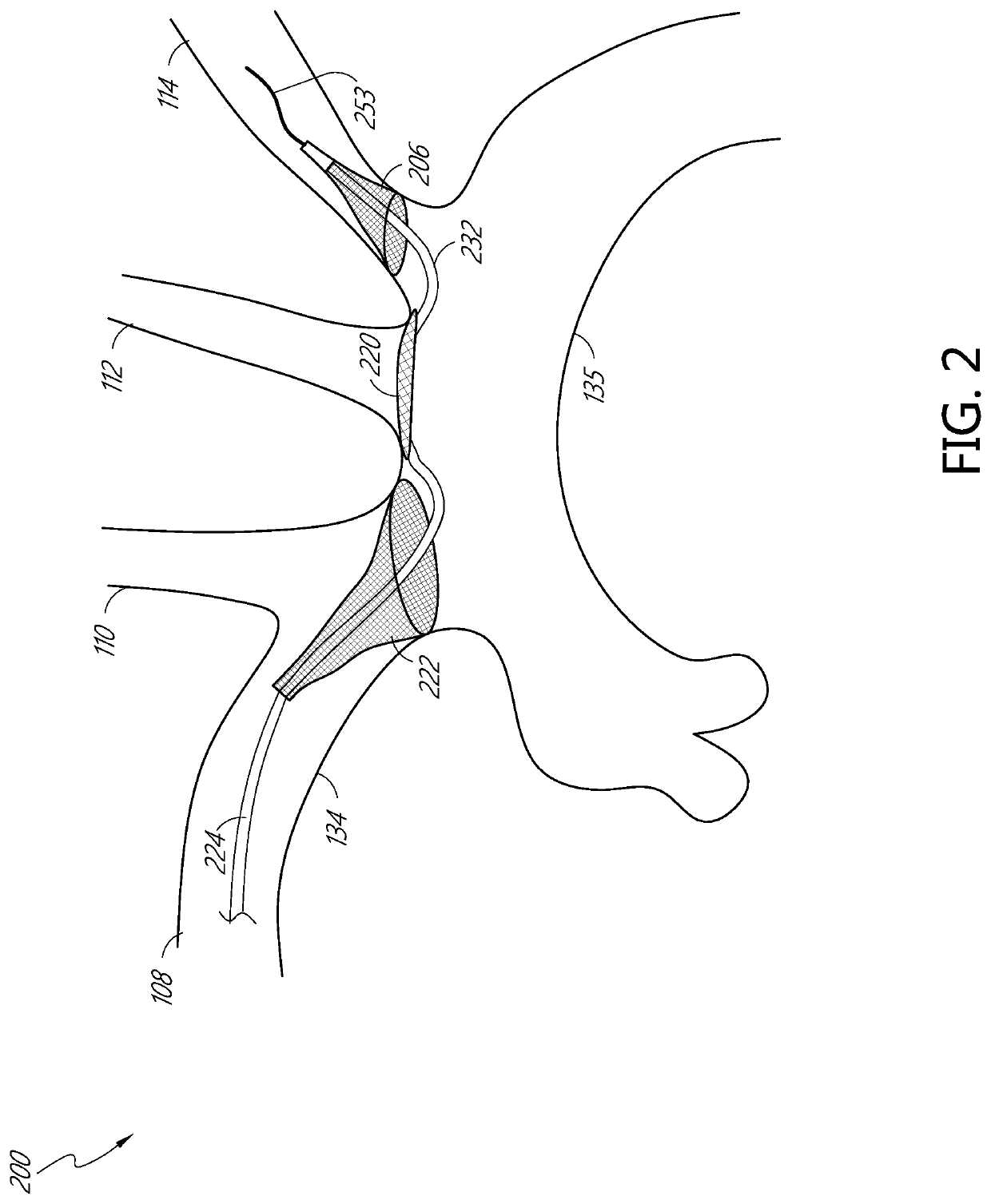 Systems and methods for protecting the cerebral vasculature
