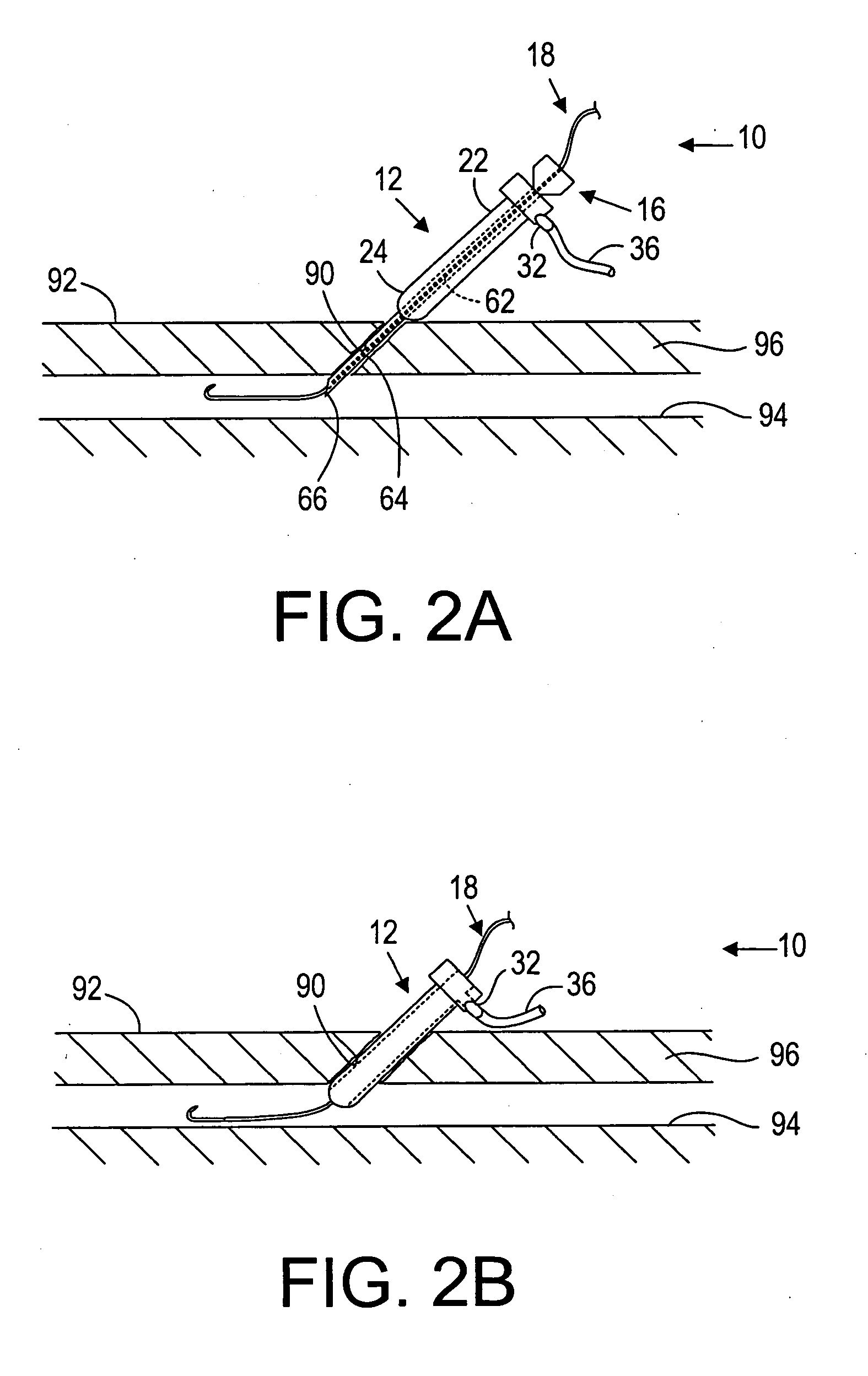 Apparatus and methods for delivering sealing materials during a percutaneous procedure to facilitate hemostasis