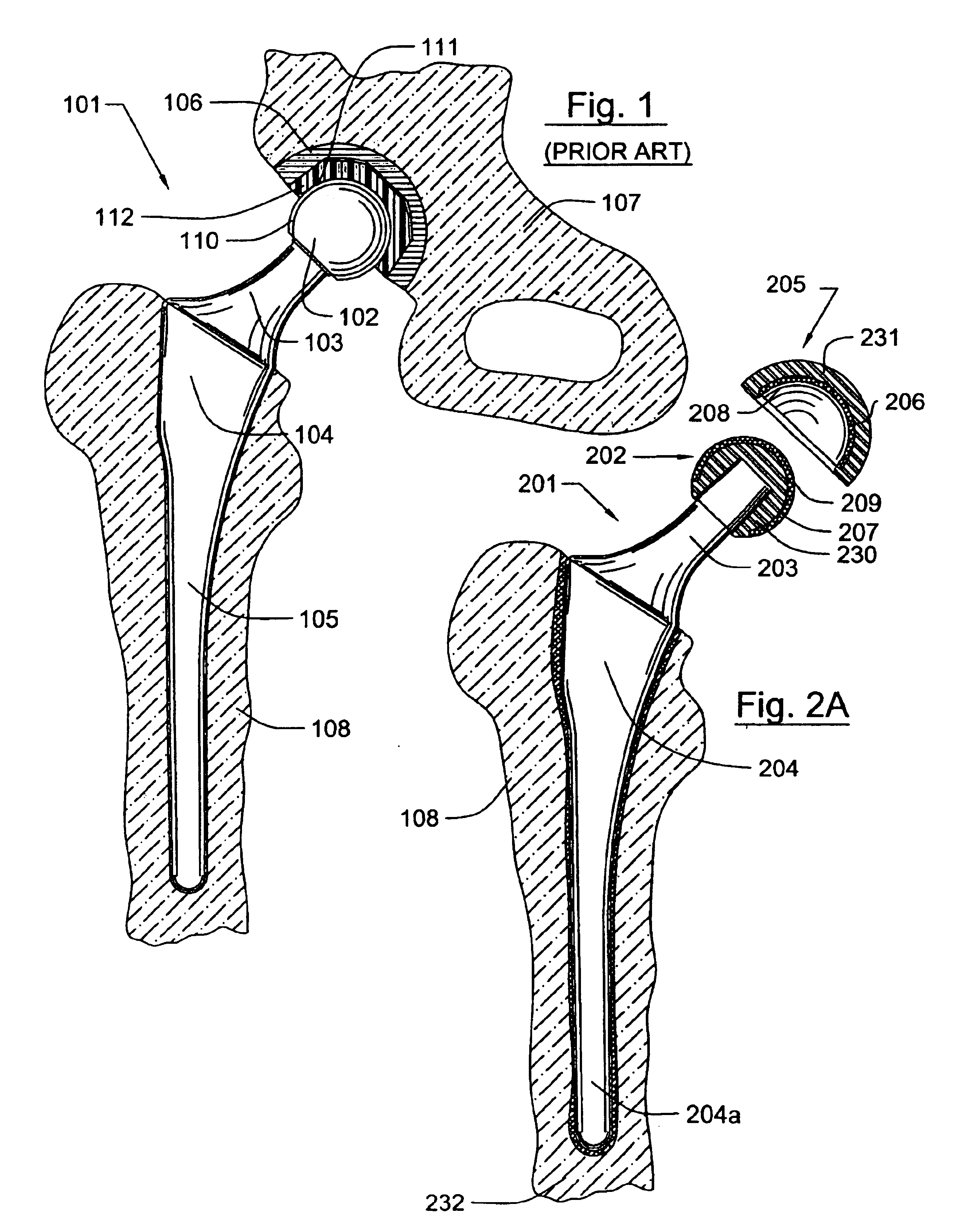 Prosthetic hip joint having a polycrystalline diamond articulation surface and a plurality of substrate layers