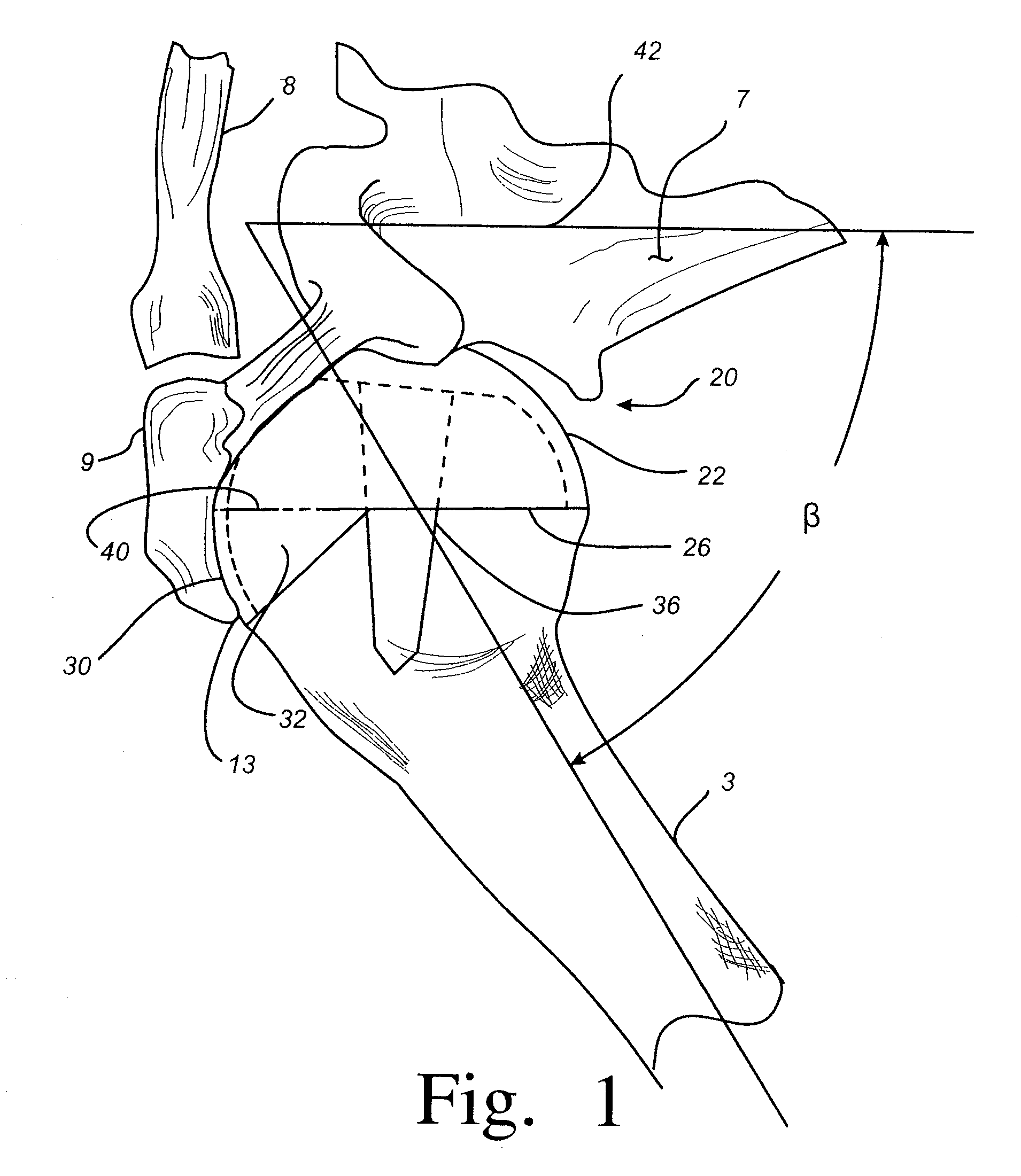 Cutting guide for use with an extended articulation orthopaedic implant