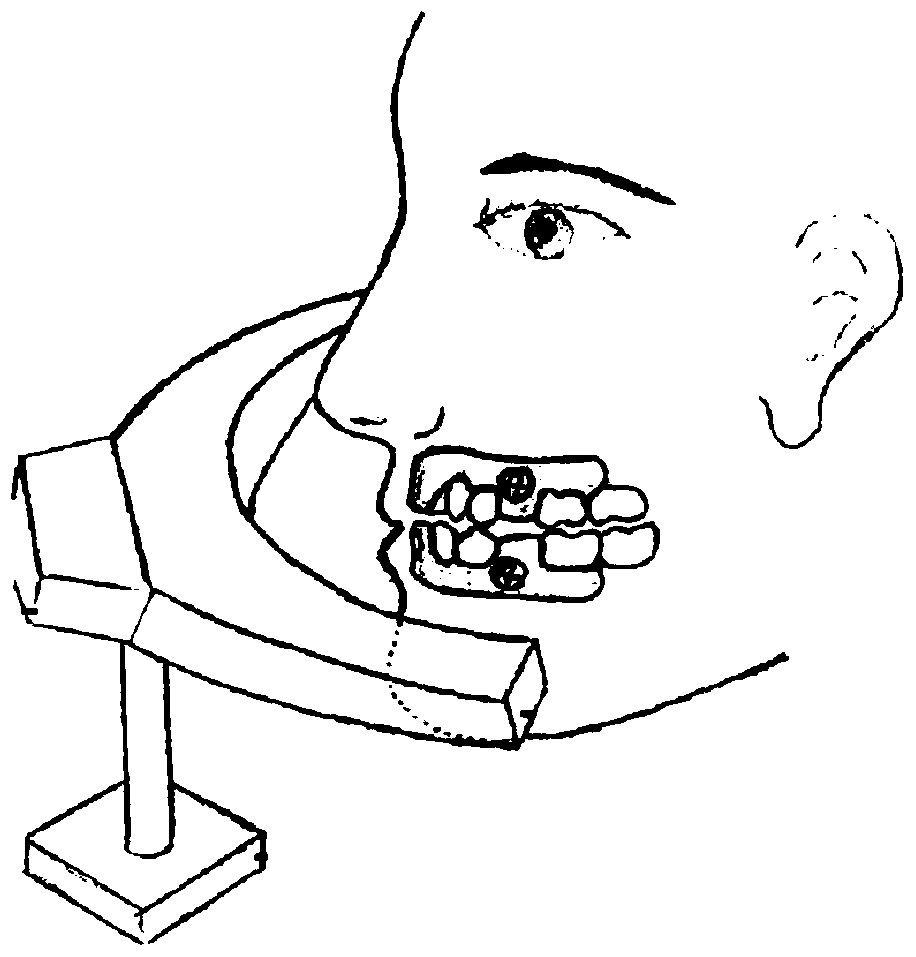 A wireless orthodontic auxiliary treatment instrument