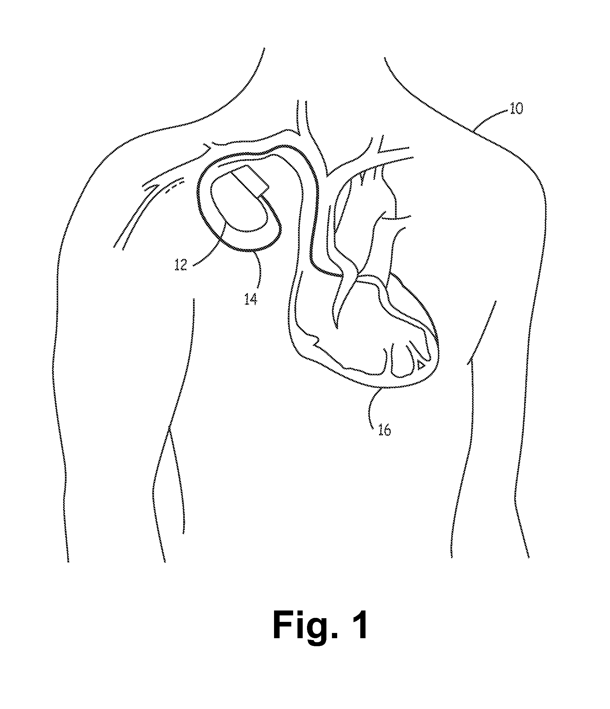 Pacing method and apparatus