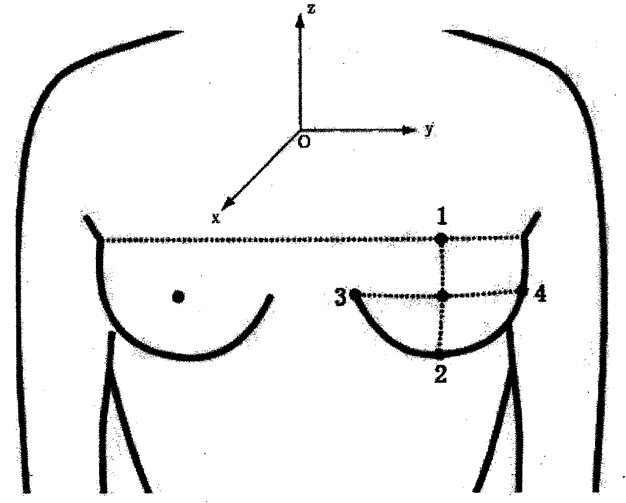Three-dimensional breast volume measurement method on basis of mesh projection process