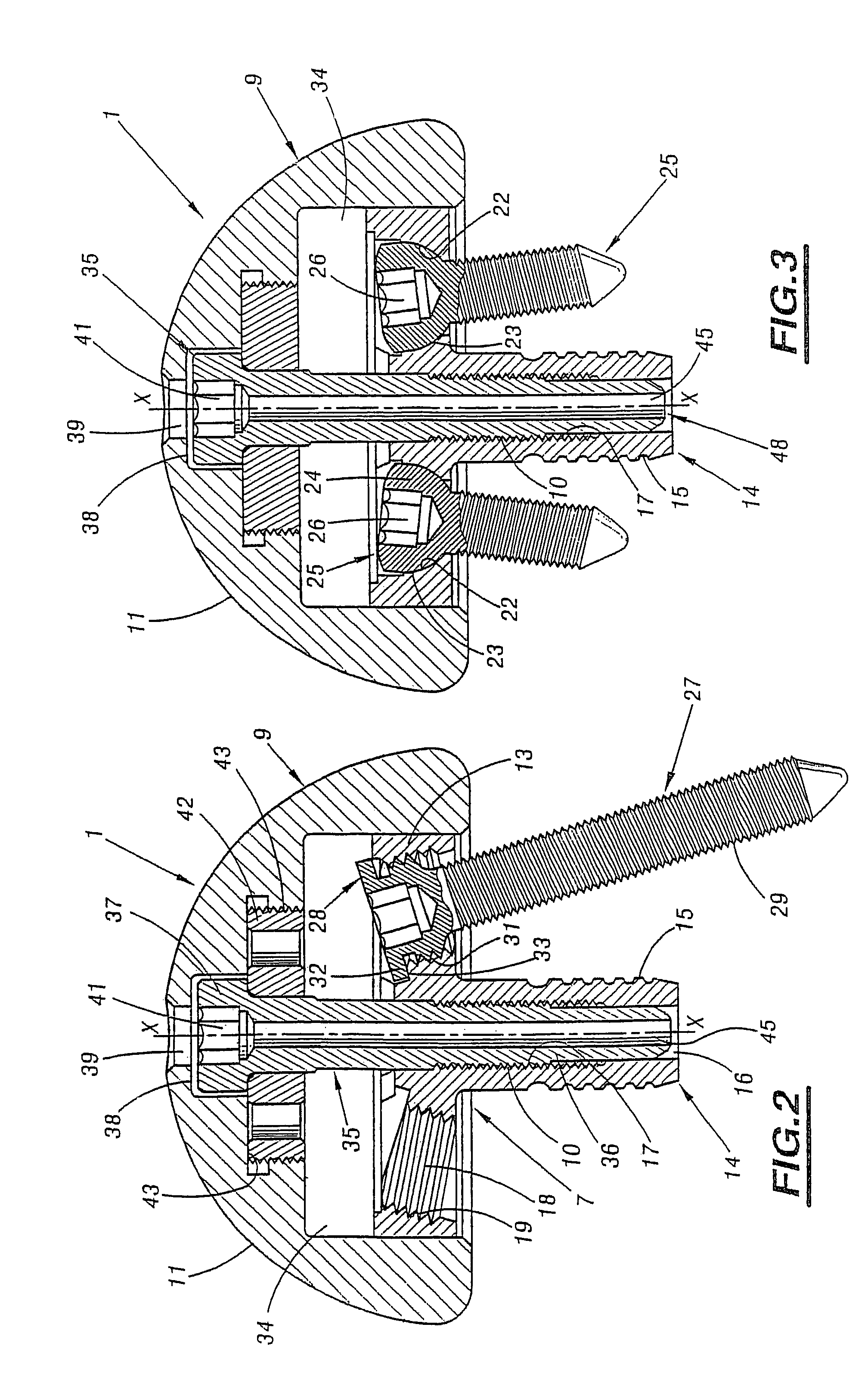 Shoulder prosthesis assembly