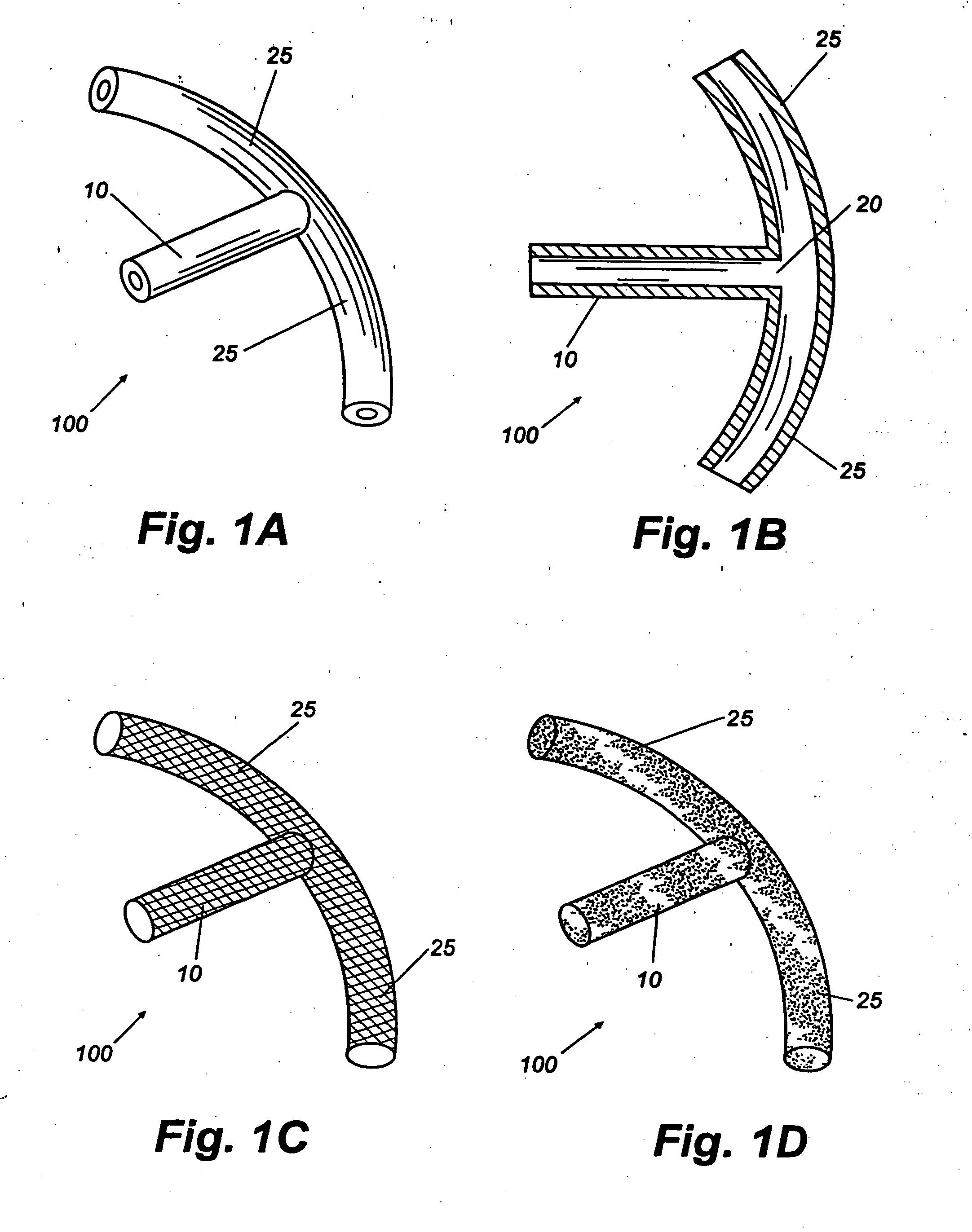 Shunt device and method for treating glaucoma