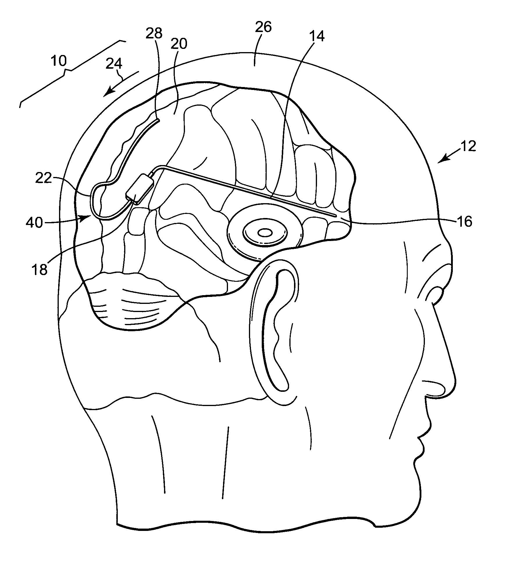 Apparatus and method for retrograde placement of sagittal sinus drainage catheter