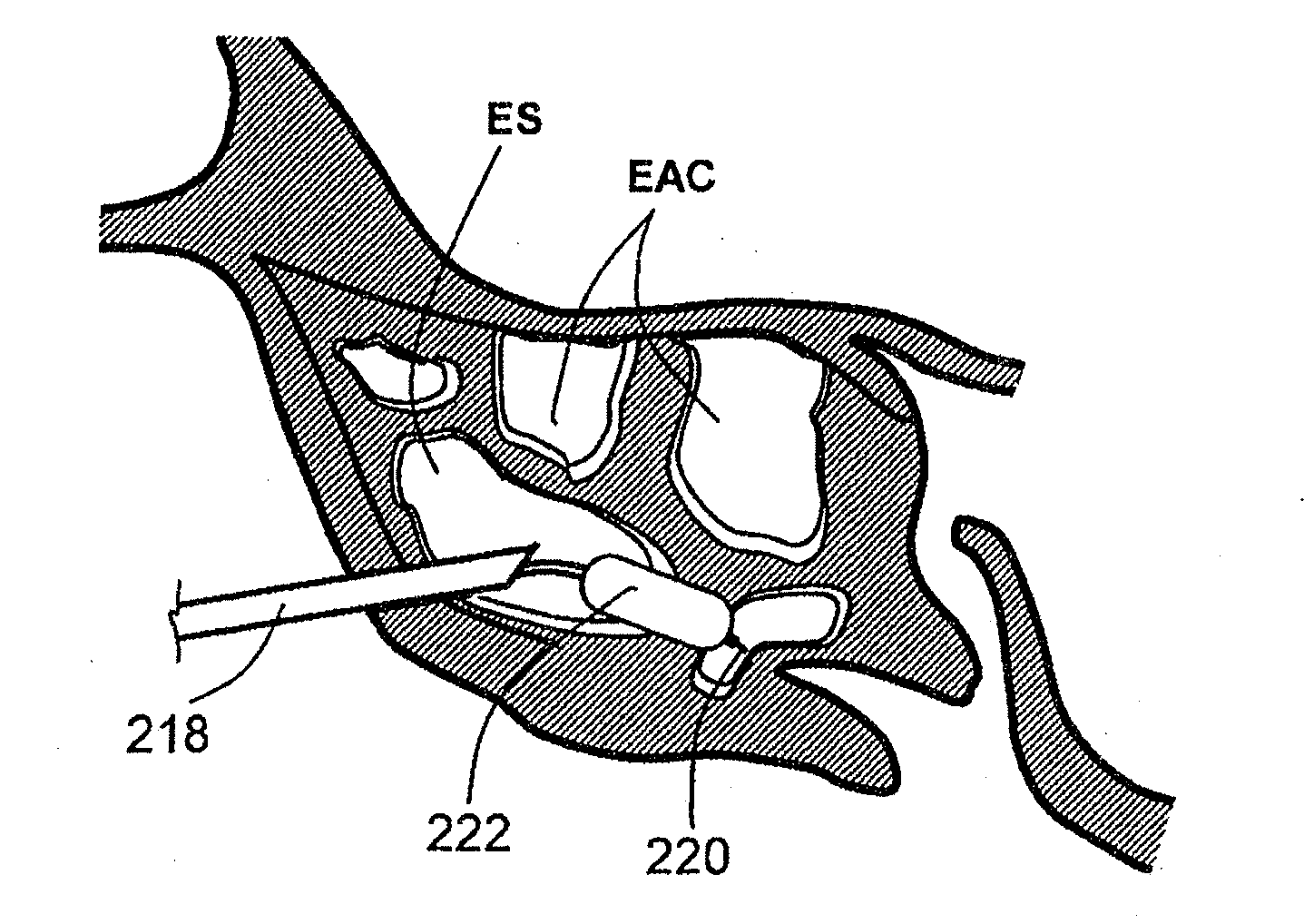 Apparatus and Methods for Dilating and Modifying Ostia of Paranasal Sinuses and Other Intranasal or Paranasal Structures
