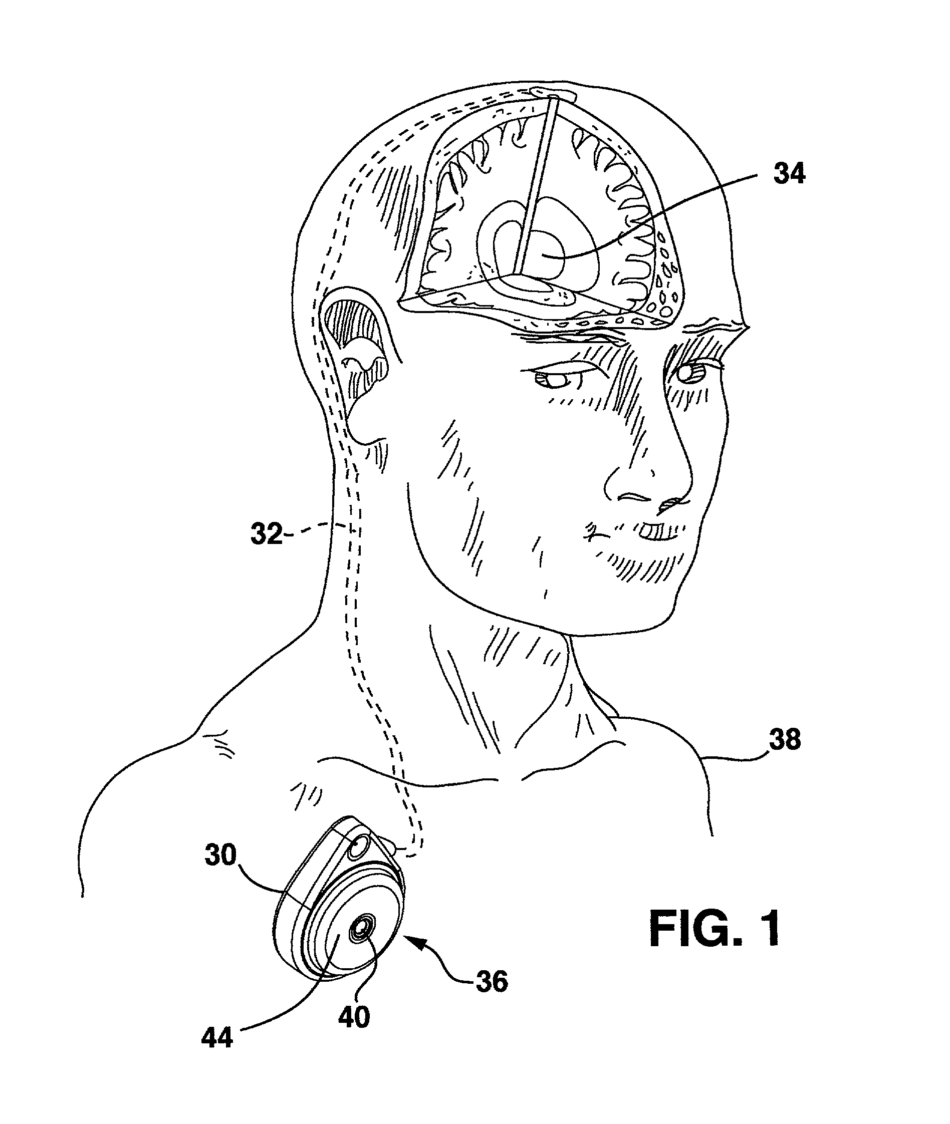Implantable infusion device with motor connection and seal system