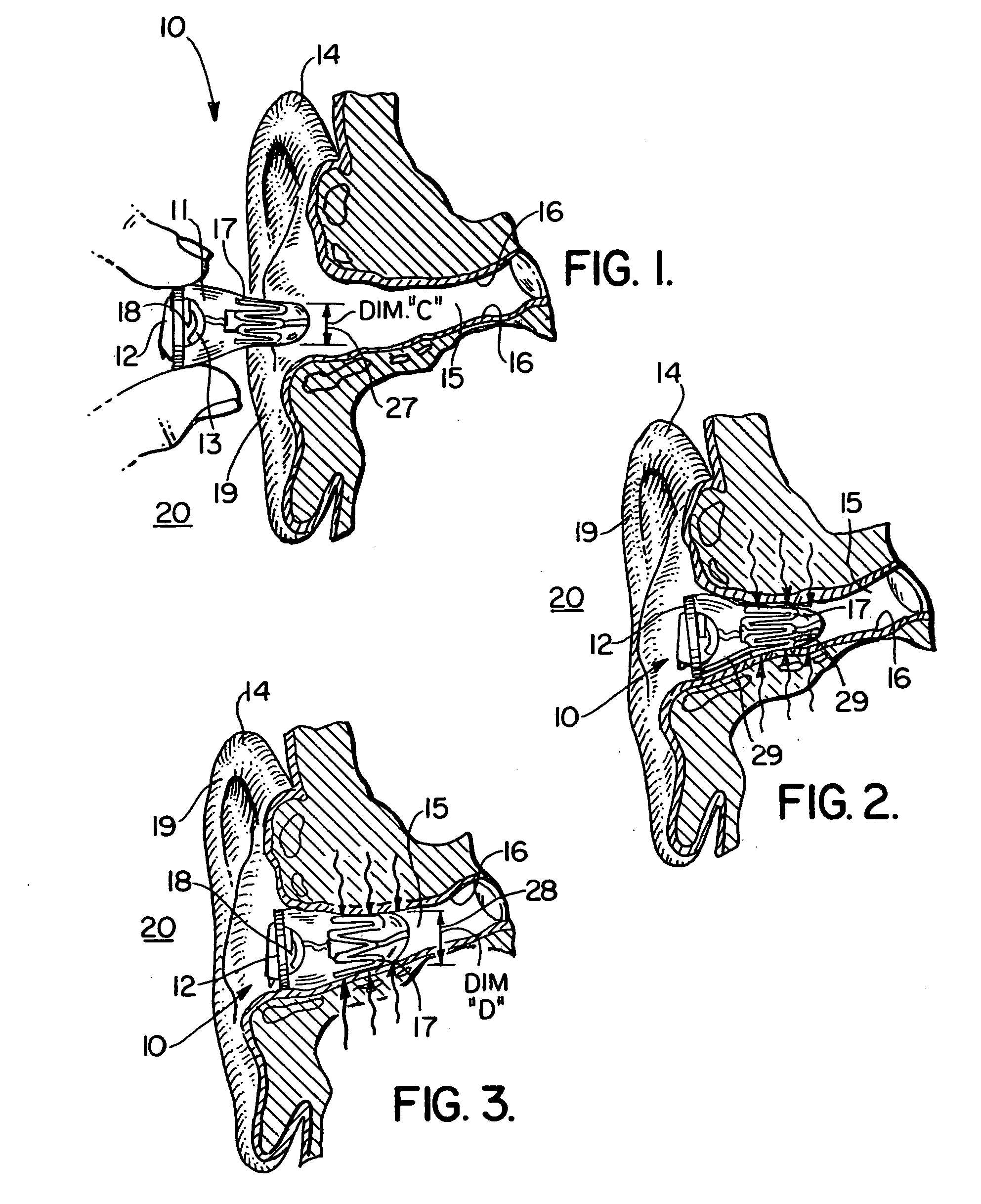 Self forming in-the-ear hearing aid