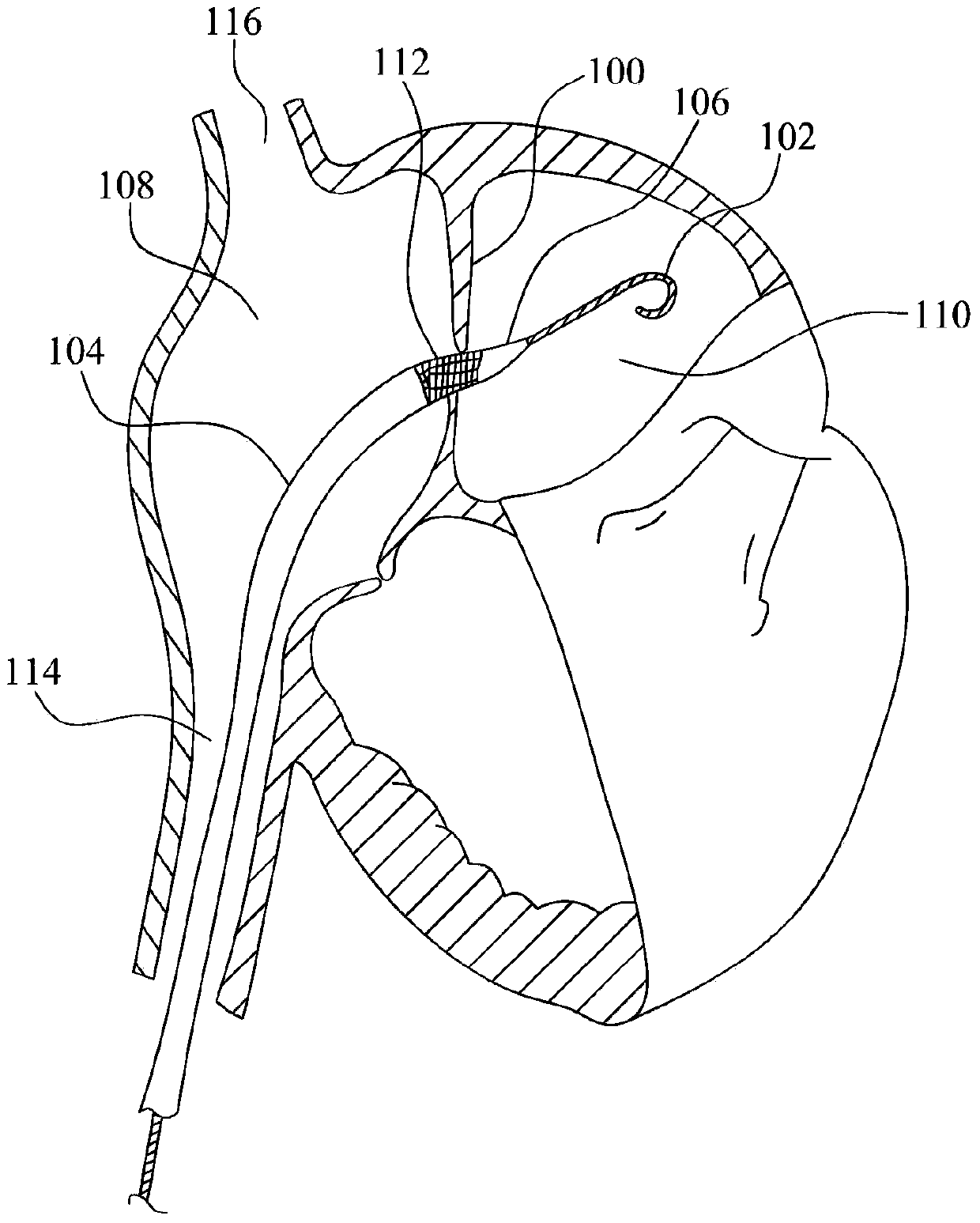 Apparatus and methods to create and maintain an intra-atrial pressure relief opening