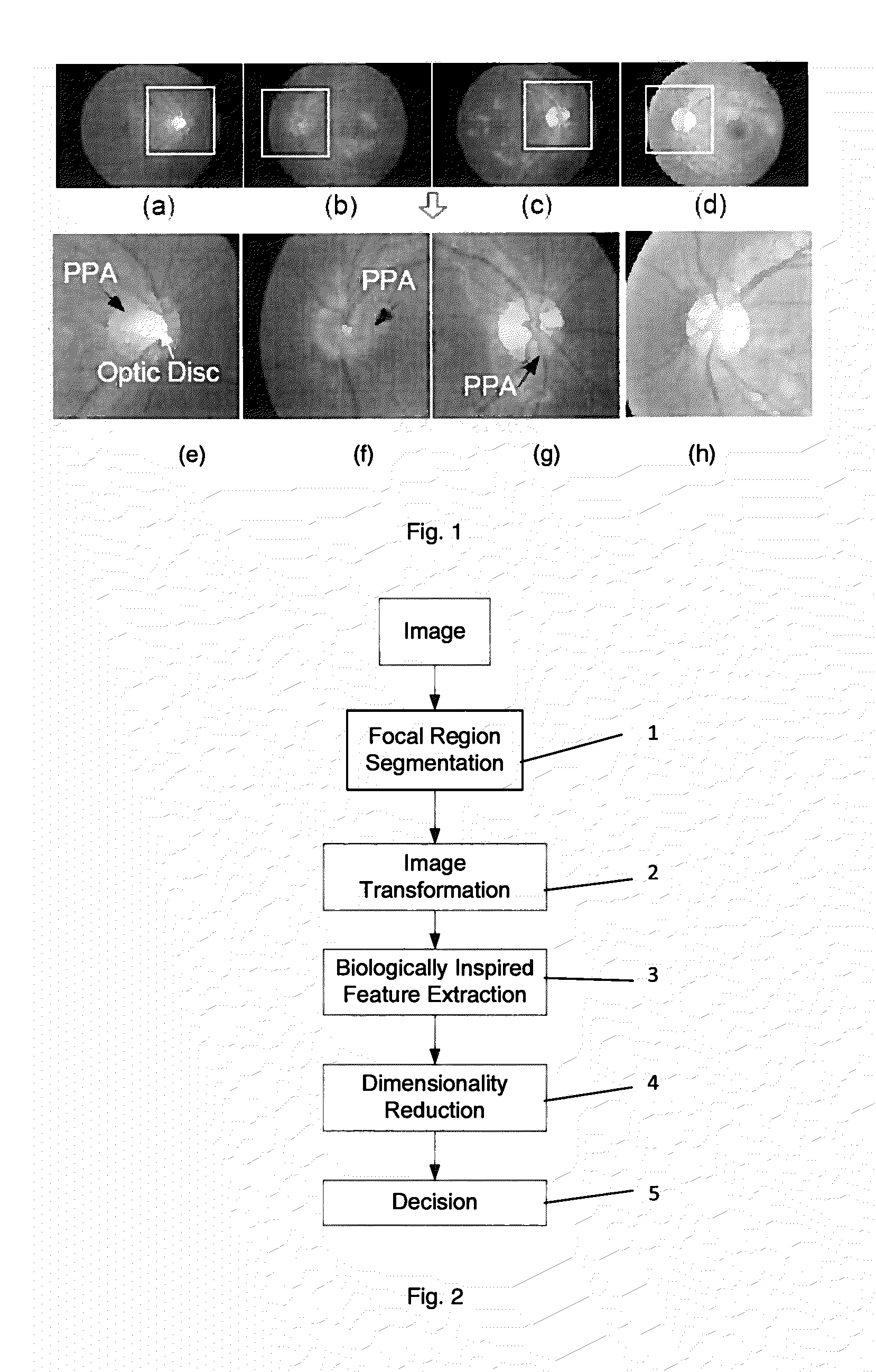 Methods and systems for detecting peripapillary atrophy