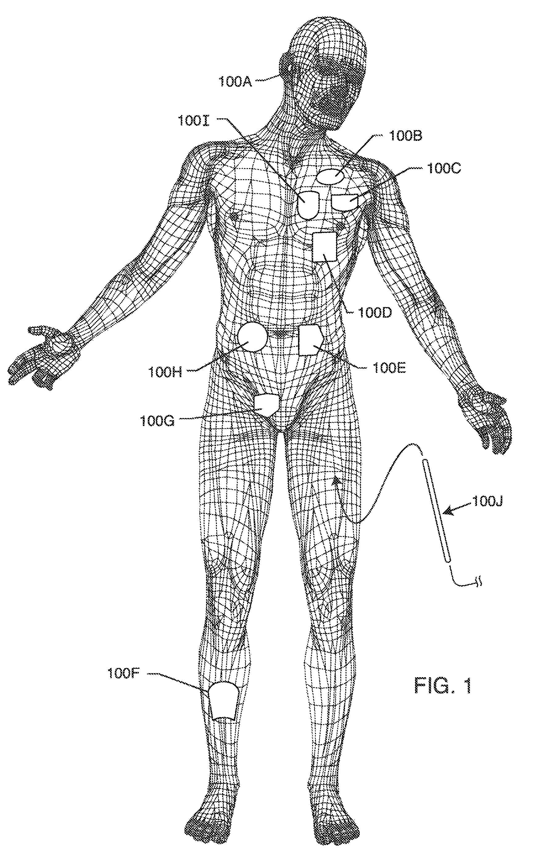 Electromagnetic shield for a passive electronic component in an active medical device implantable lead