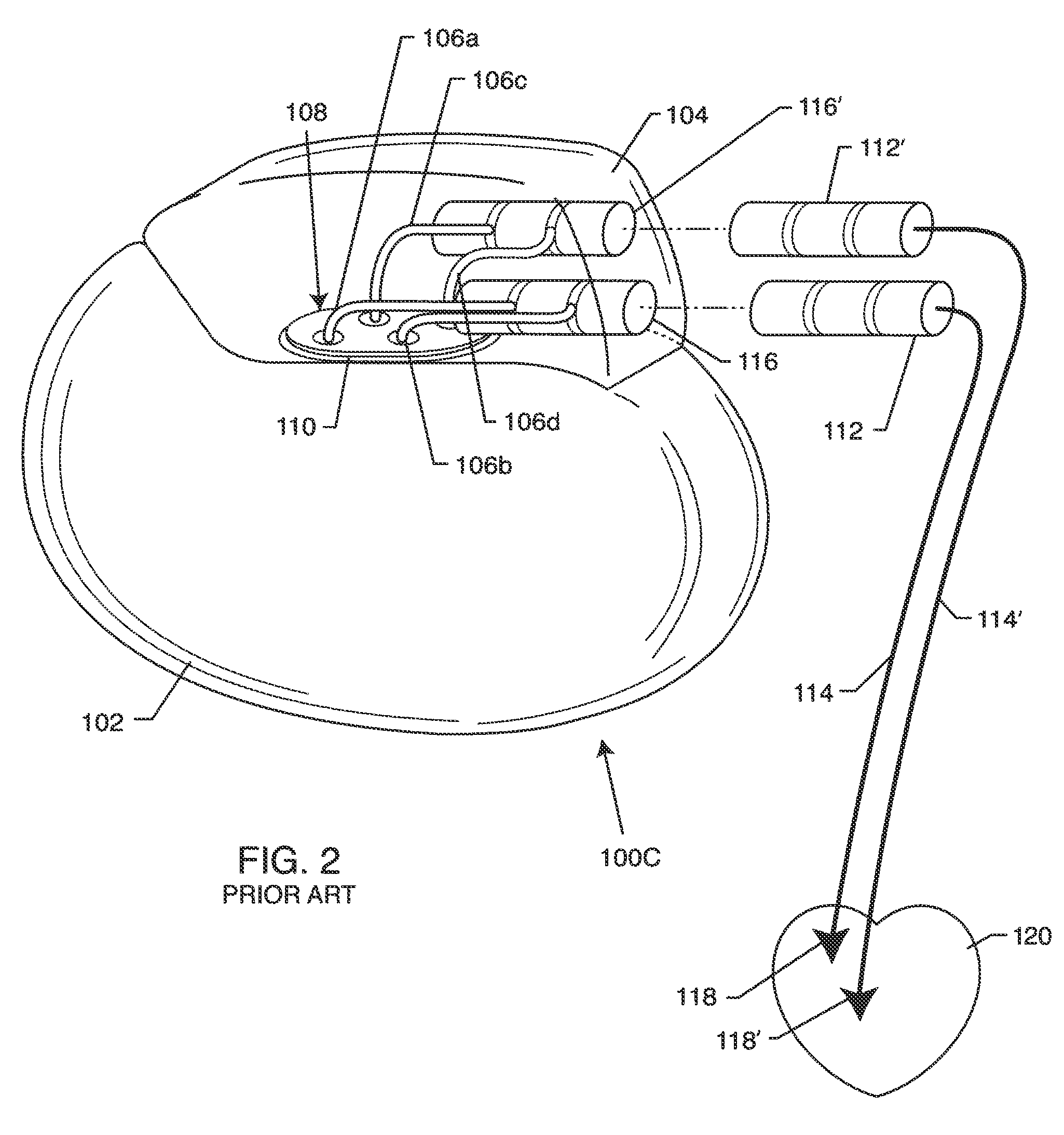 Electromagnetic shield for a passive electronic component in an active medical device implantable lead