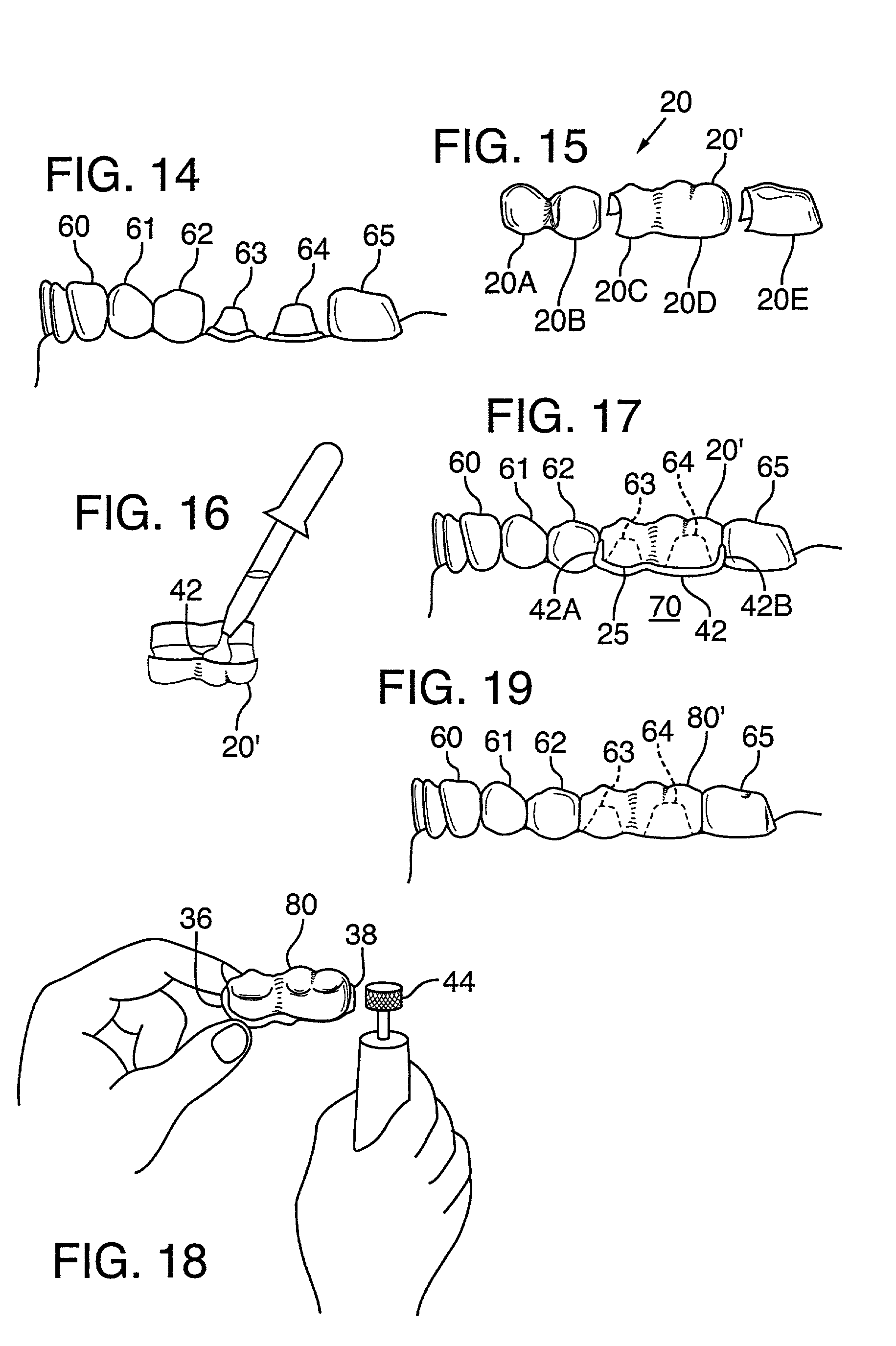 Quadrant and anterior dental shells and method of making a multi-tooth crown or bridge