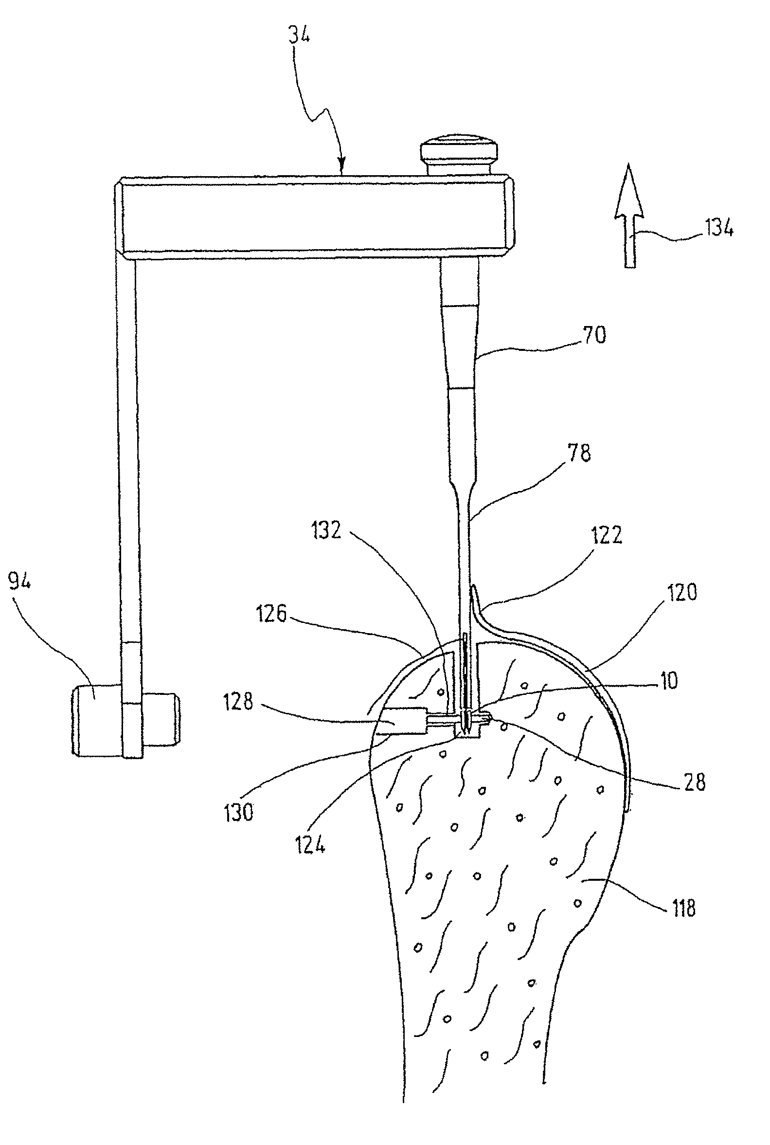 Instrument Set For Fixing An Implant In A Bone
