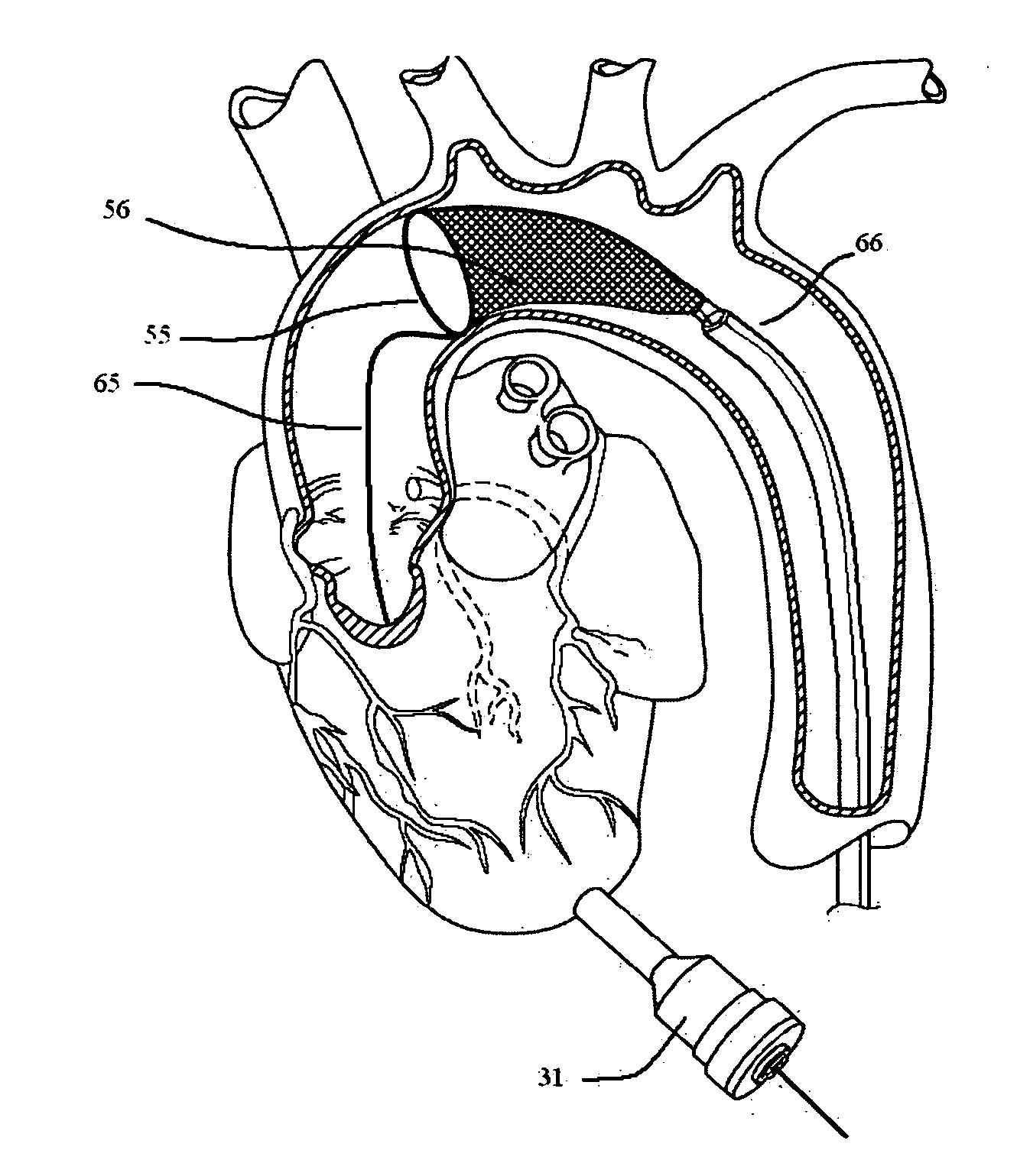 Methods and systems for cardiac valve delivery