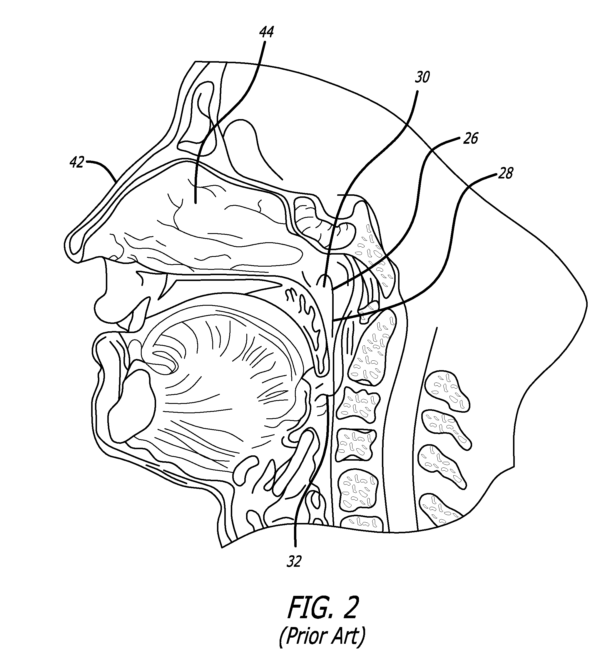 System and Method For Treatment of Non-Ventilating Middle Ear by Providing a Gas Pathway Through the Nasopharynx