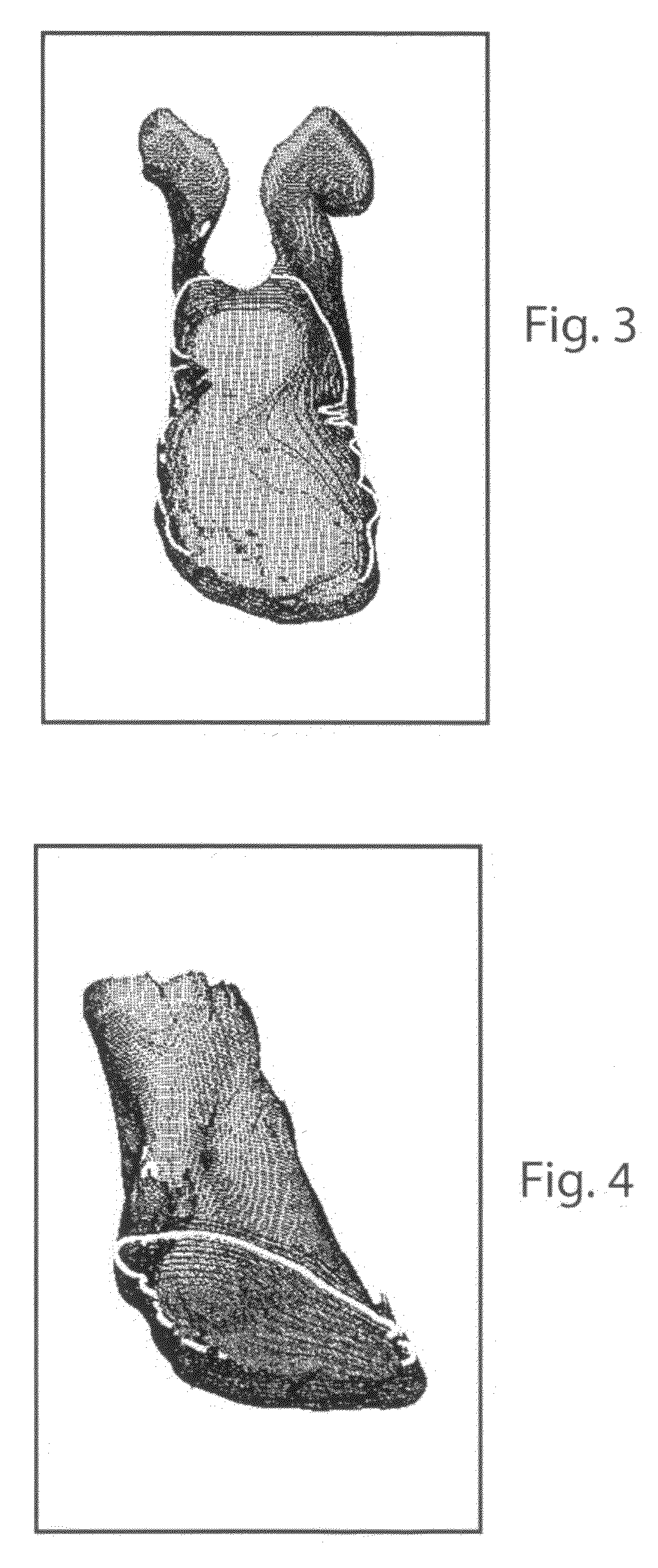 System and method for evaluating the needs of a person and manufacturing a custom orthotic device